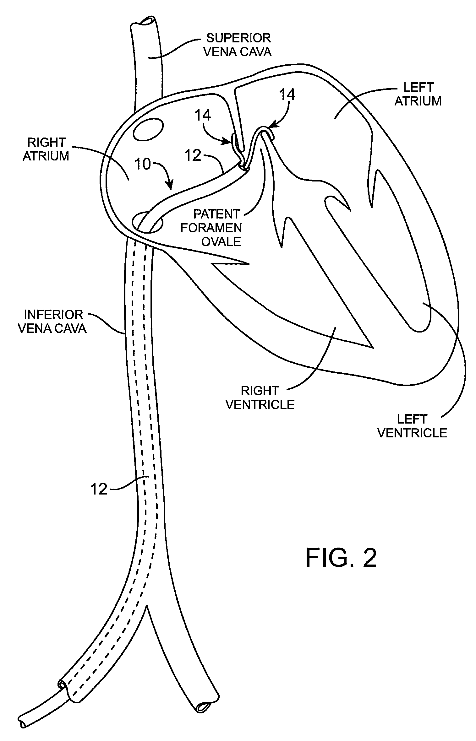 Energy based devices and methods for treatment of patent foramen ovale
