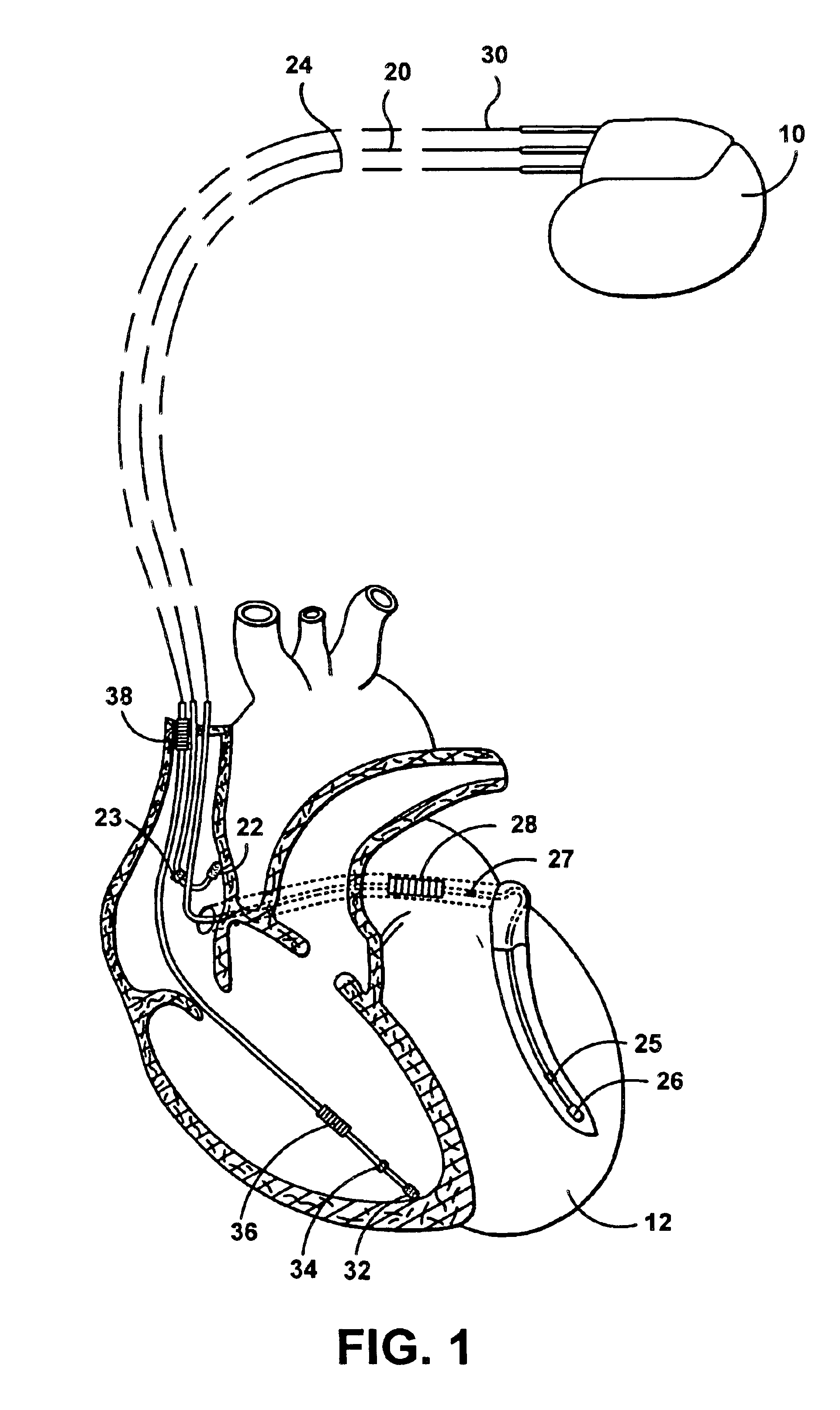 Apparatus and method for automatically sensing threshold histogram with differentiation of sinus from ectopic beats