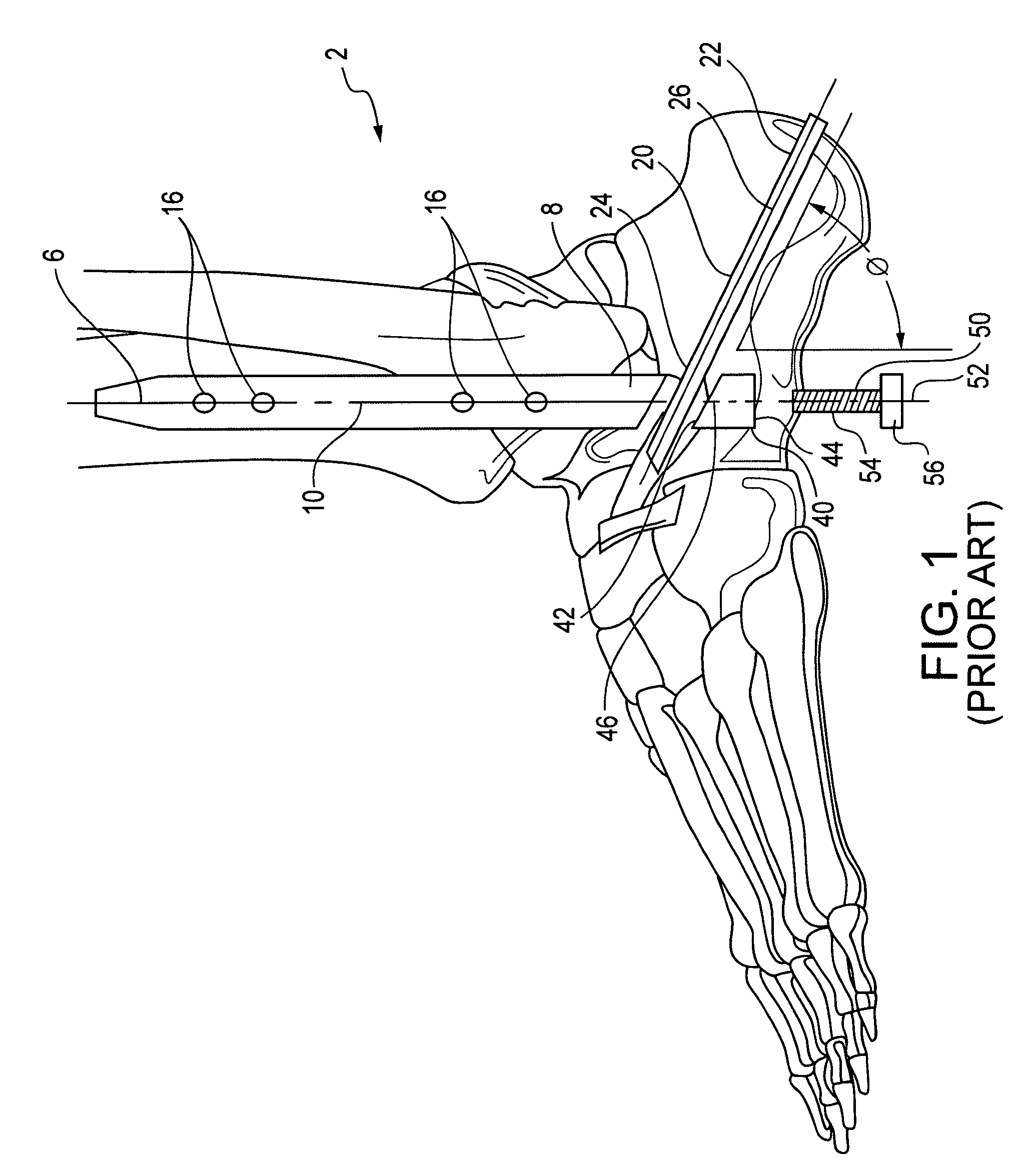 Modular, blade-rod, intramedullary fixation device