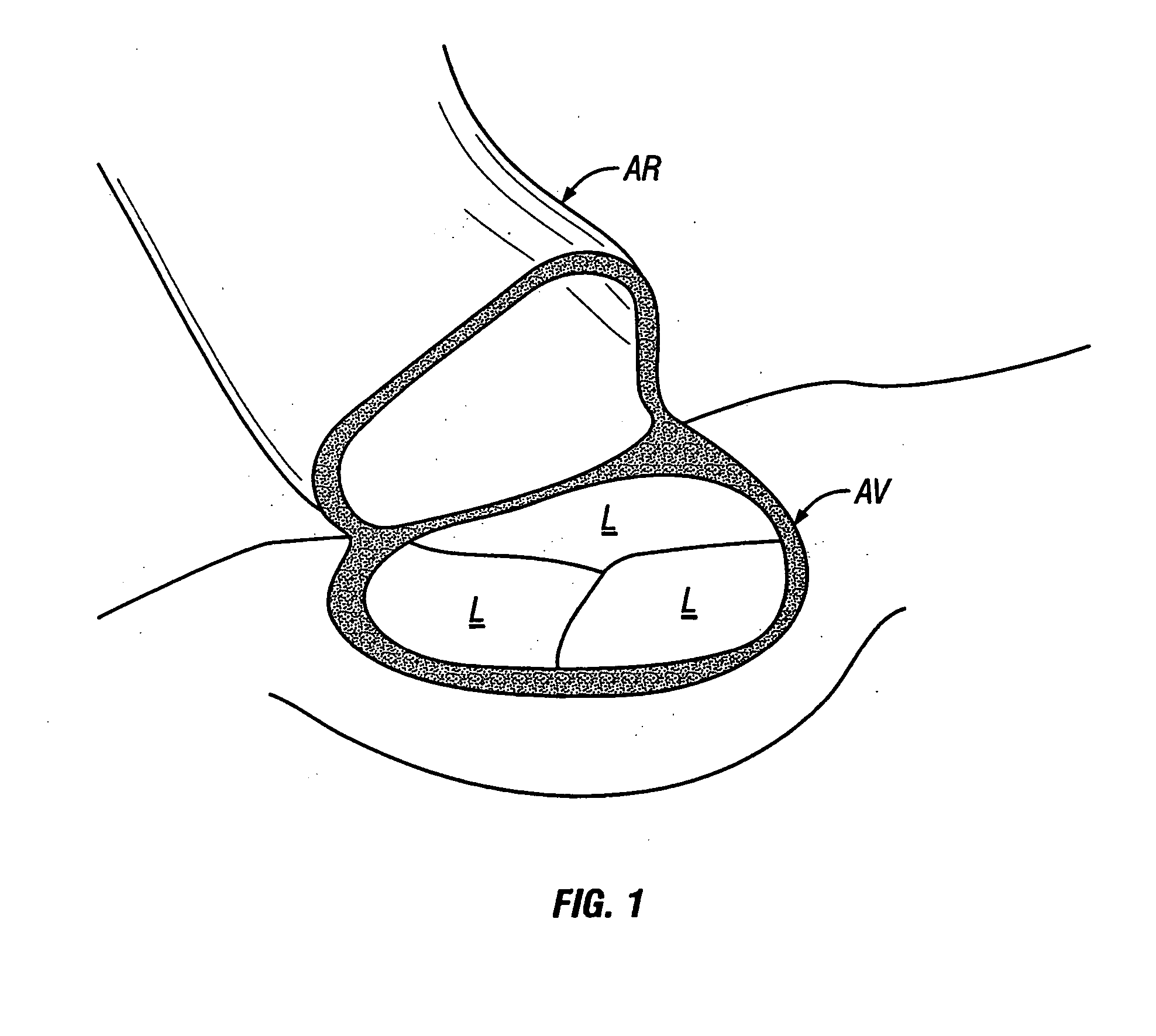 Methods and apparatus for off pump aortic valve replacement with a valve prosthesis