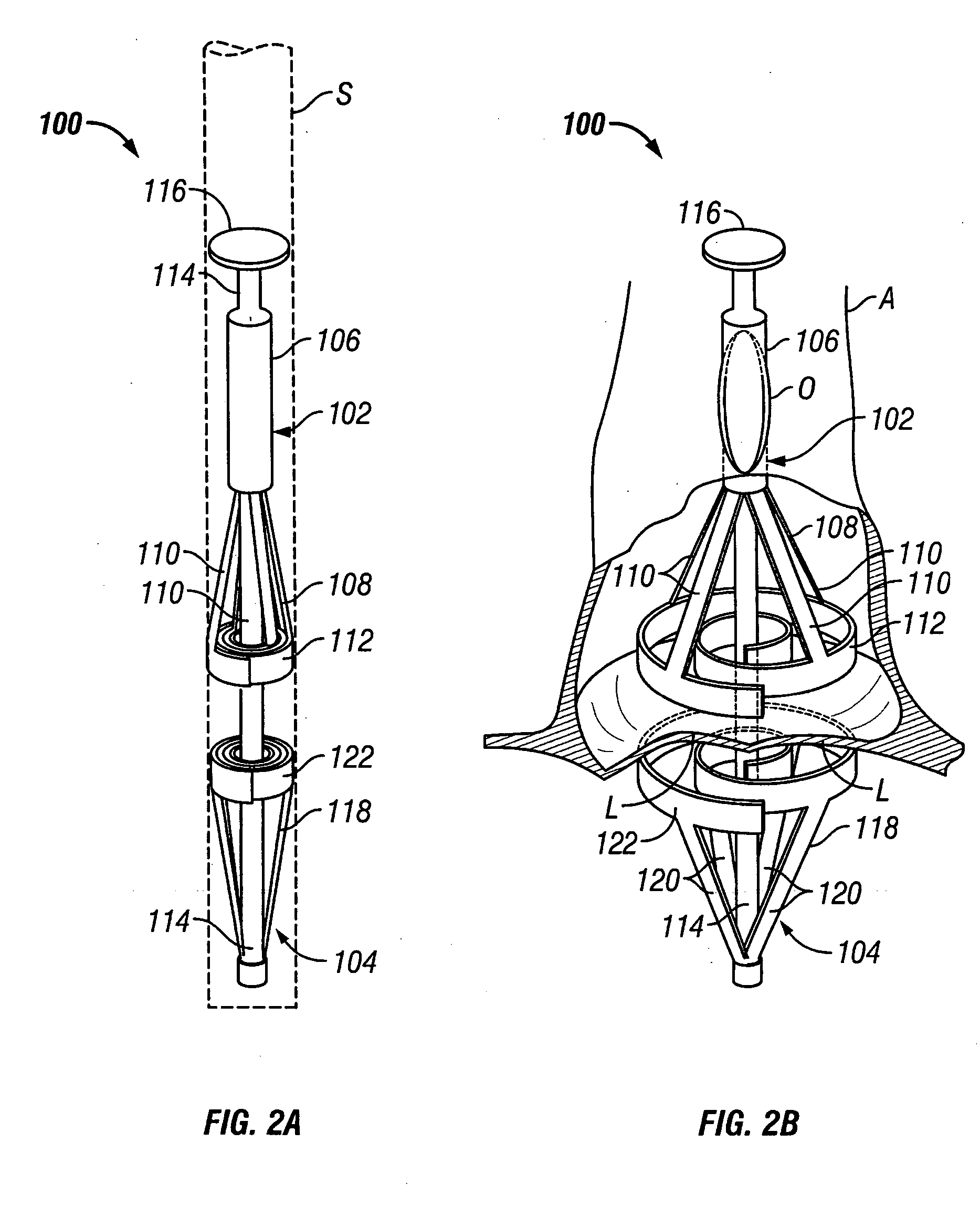 Methods and apparatus for off pump aortic valve replacement with a valve prosthesis