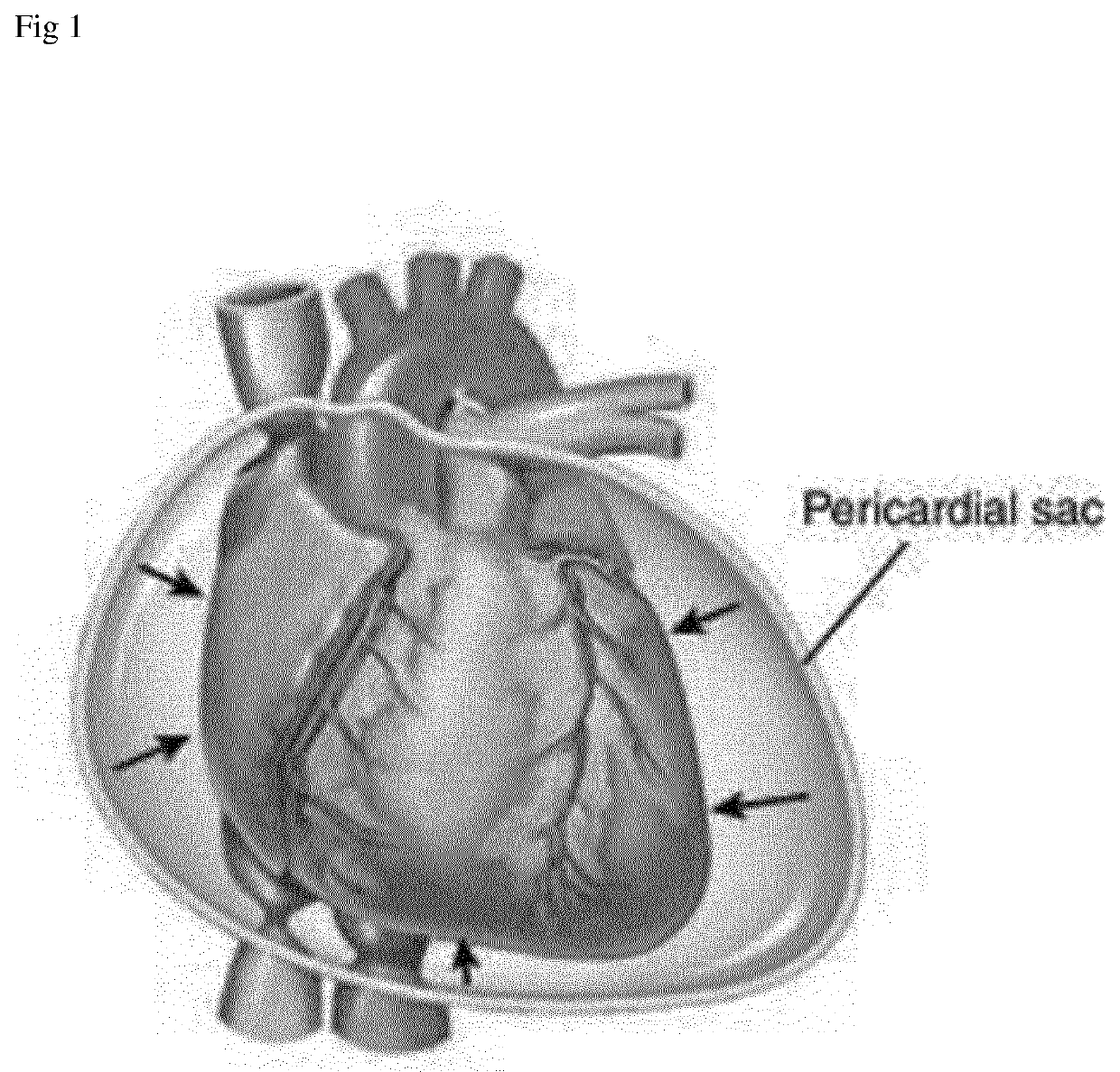 Device and Method for Diagnosis of Cardiac Tamponade