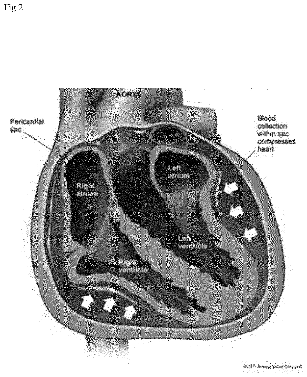 Device and Method for Diagnosis of Cardiac Tamponade