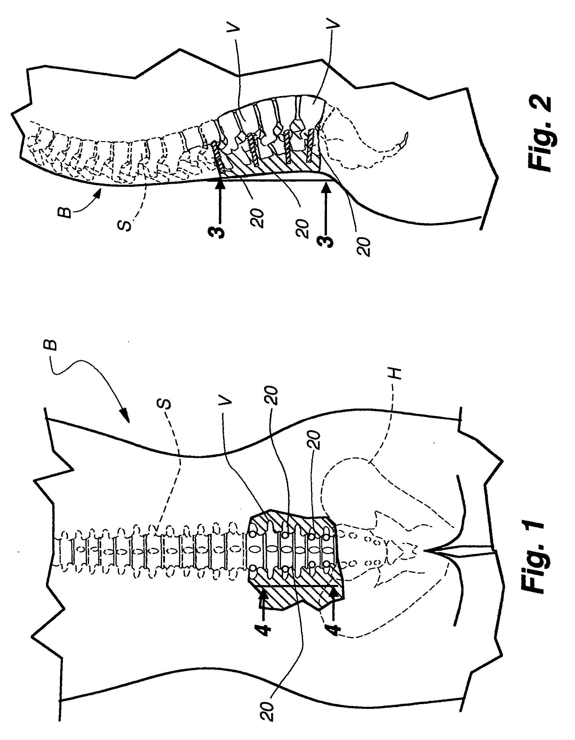 Minimally invasive pedicle screw and guide support