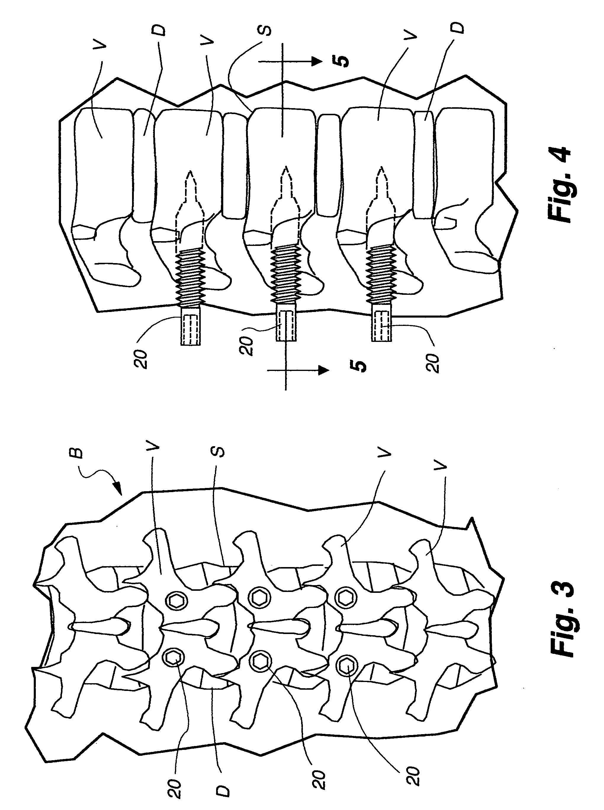 Minimally invasive pedicle screw and guide support