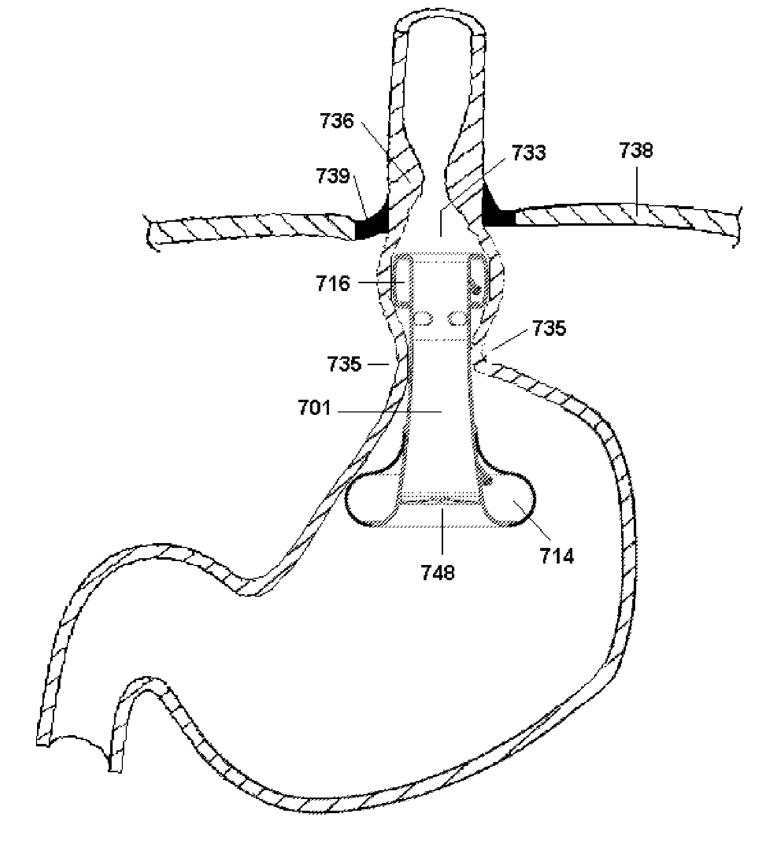 Anti-Reflux Devices and Methods for Treating Gastro-Esophageal Reflux Disease (GERD)