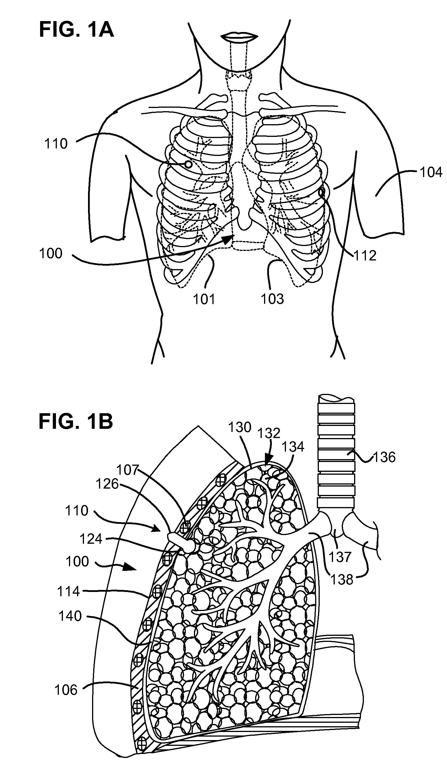 Variable length pneumostoma management system for treatment of chronic obstructive pulmonary disease