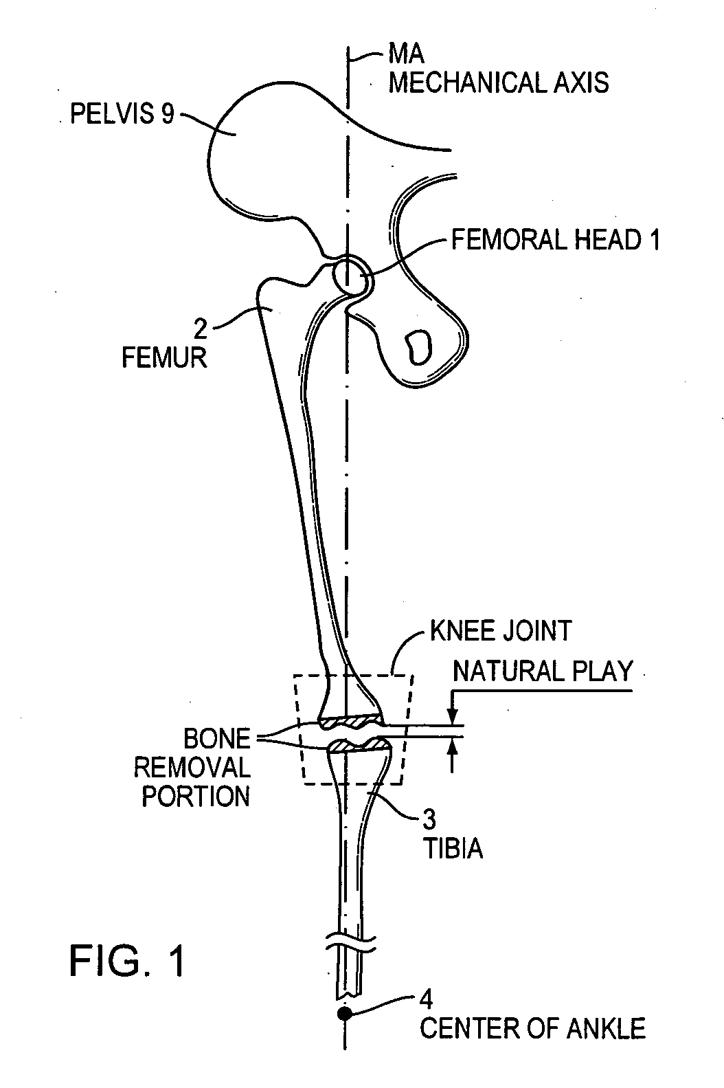 Method and apparatus for aligning a knee for surgery or the like