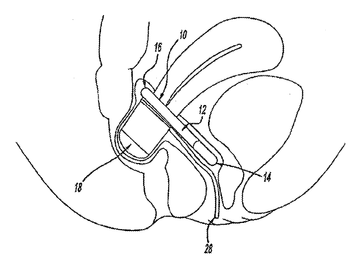 Intra-Vaginal Devices and Methods for Treating Fecal Incontinence