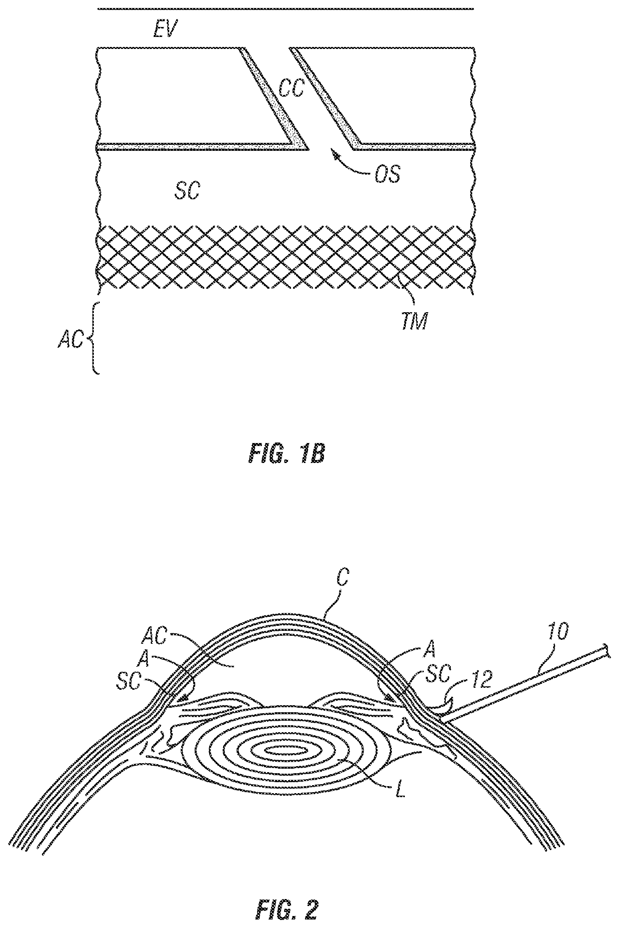 Devices and methods for treating aqueous collector channels of an eye to reduce intraocular pressure