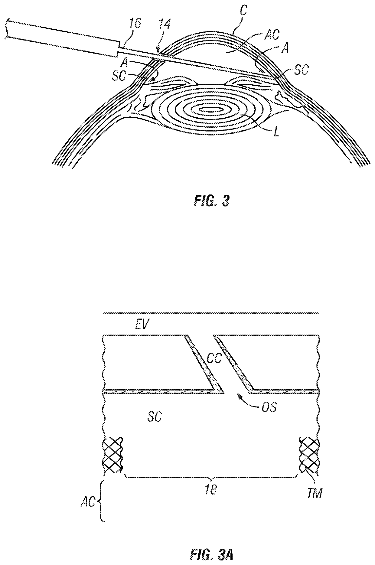 Devices and methods for treating aqueous collector channels of an eye to reduce intraocular pressure