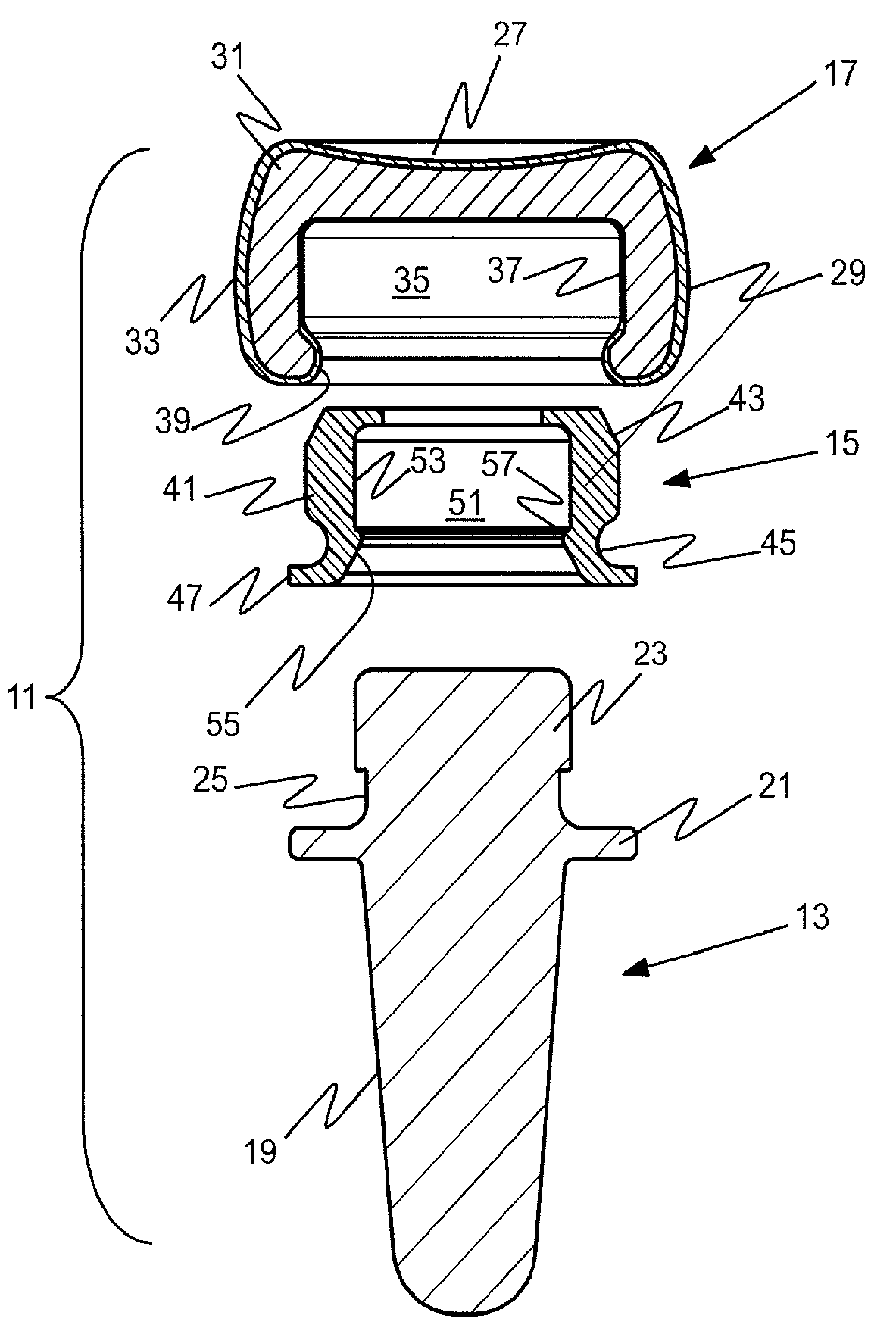 Prosthetic implant and assembly method