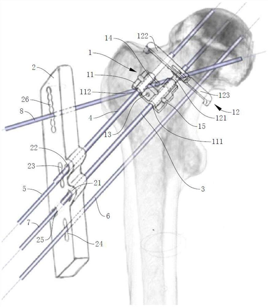 Screw guider for open reduction of femoral neck fracture and use method of screw guider