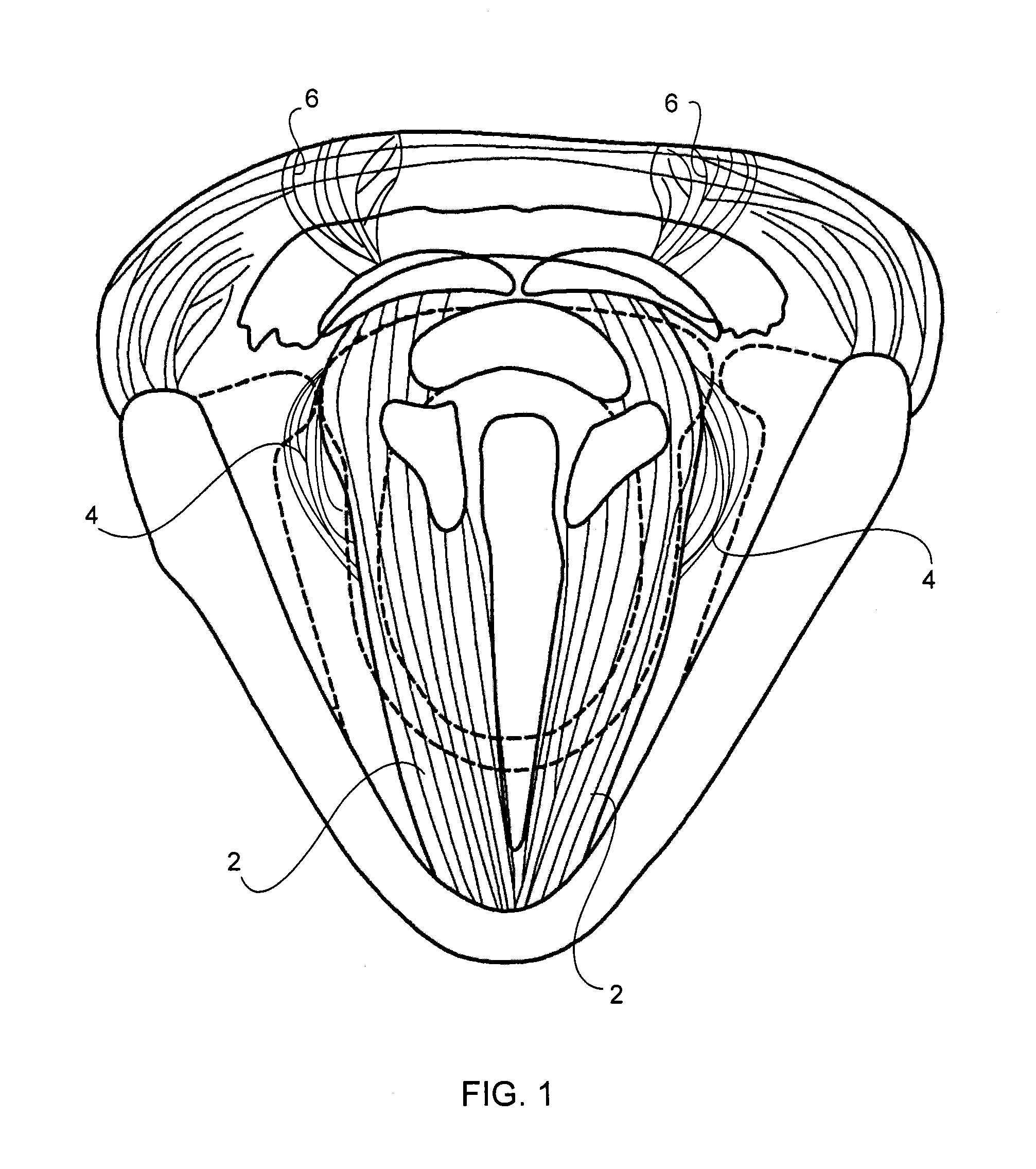 Method and apparatus for the treatment of focal dystonia