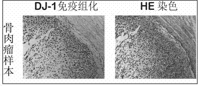 Application of DJ-1 protein in preparation of product for diagnosis and therapy of osteosarcoma