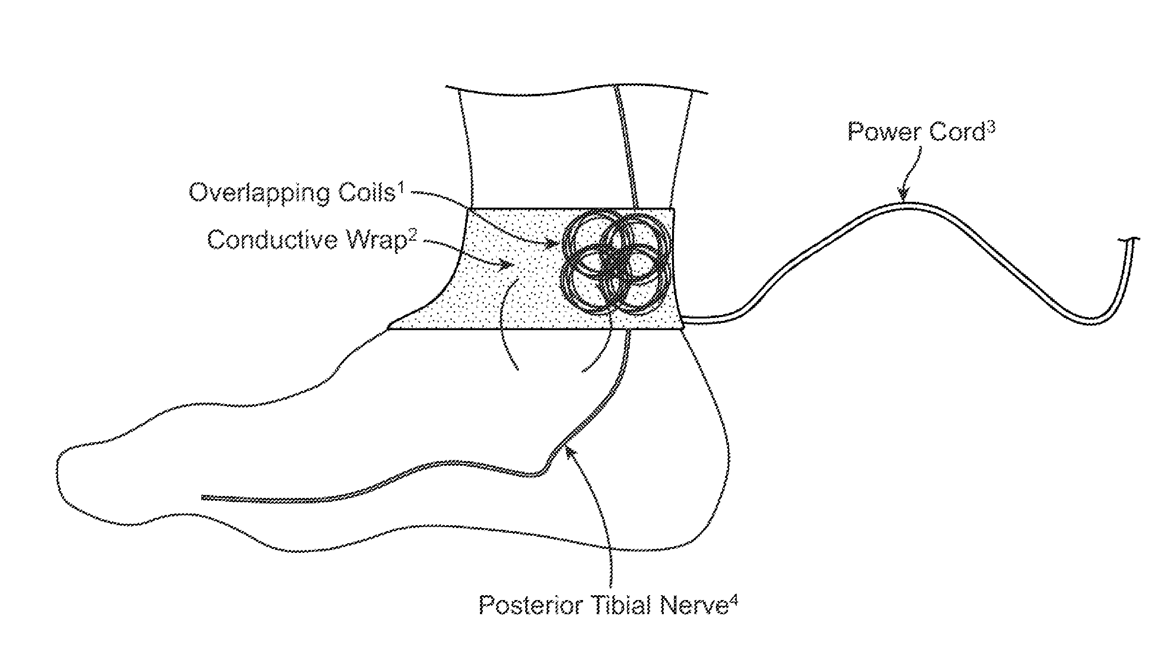 Method and apparatus for low frequency induction therapy for the treatment of urinary incontinence and overactive bladder
