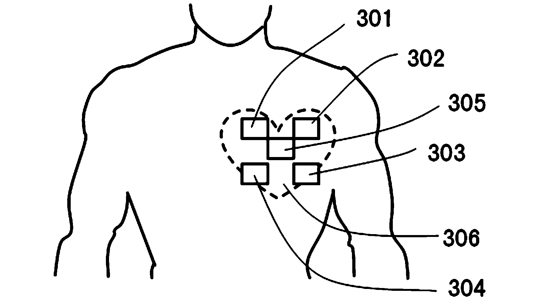 System for identifying and diagnosing rheumatic heart disease based on sound sensors and diagnostic method