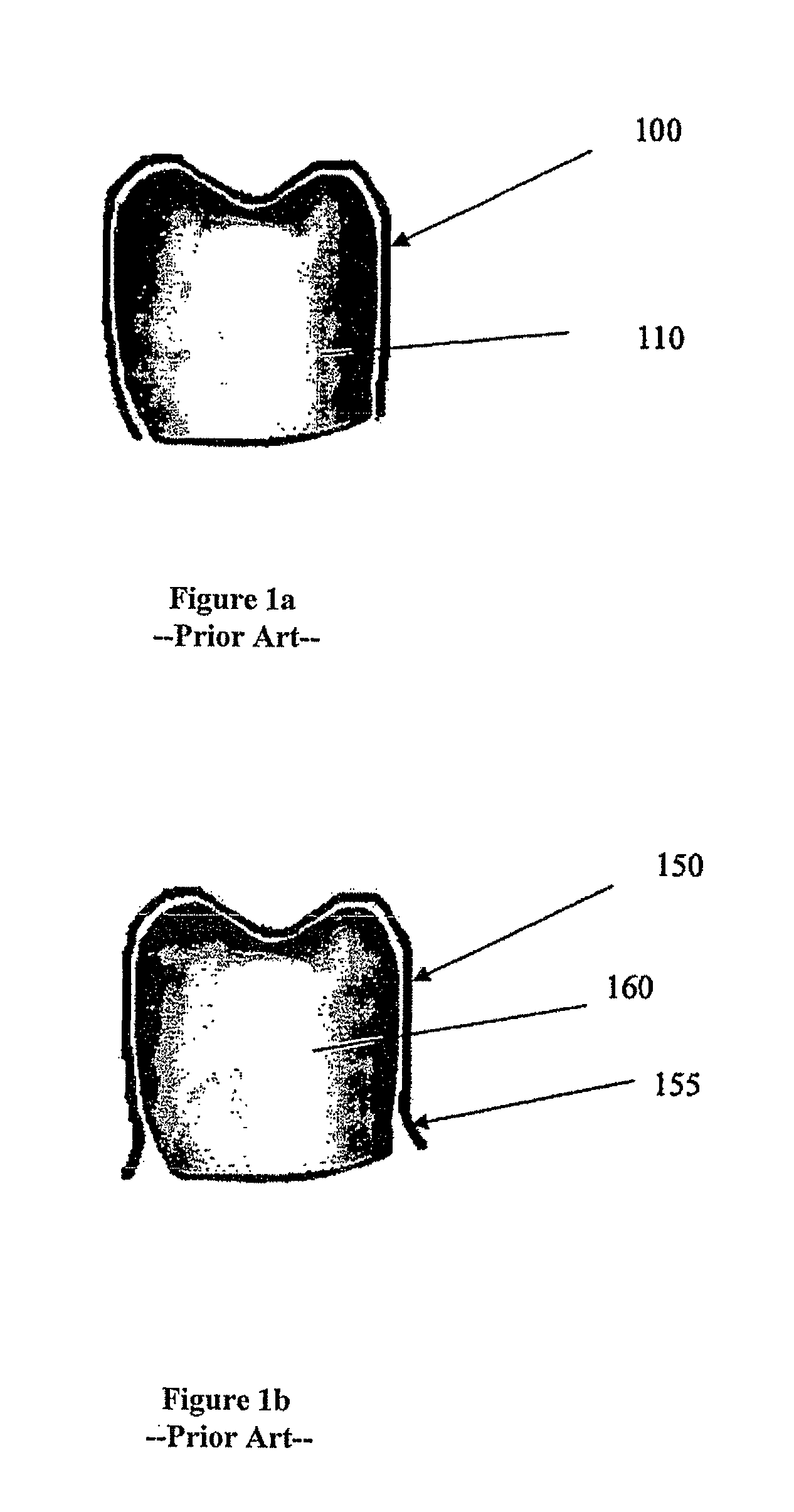 Disposable dental aligner
