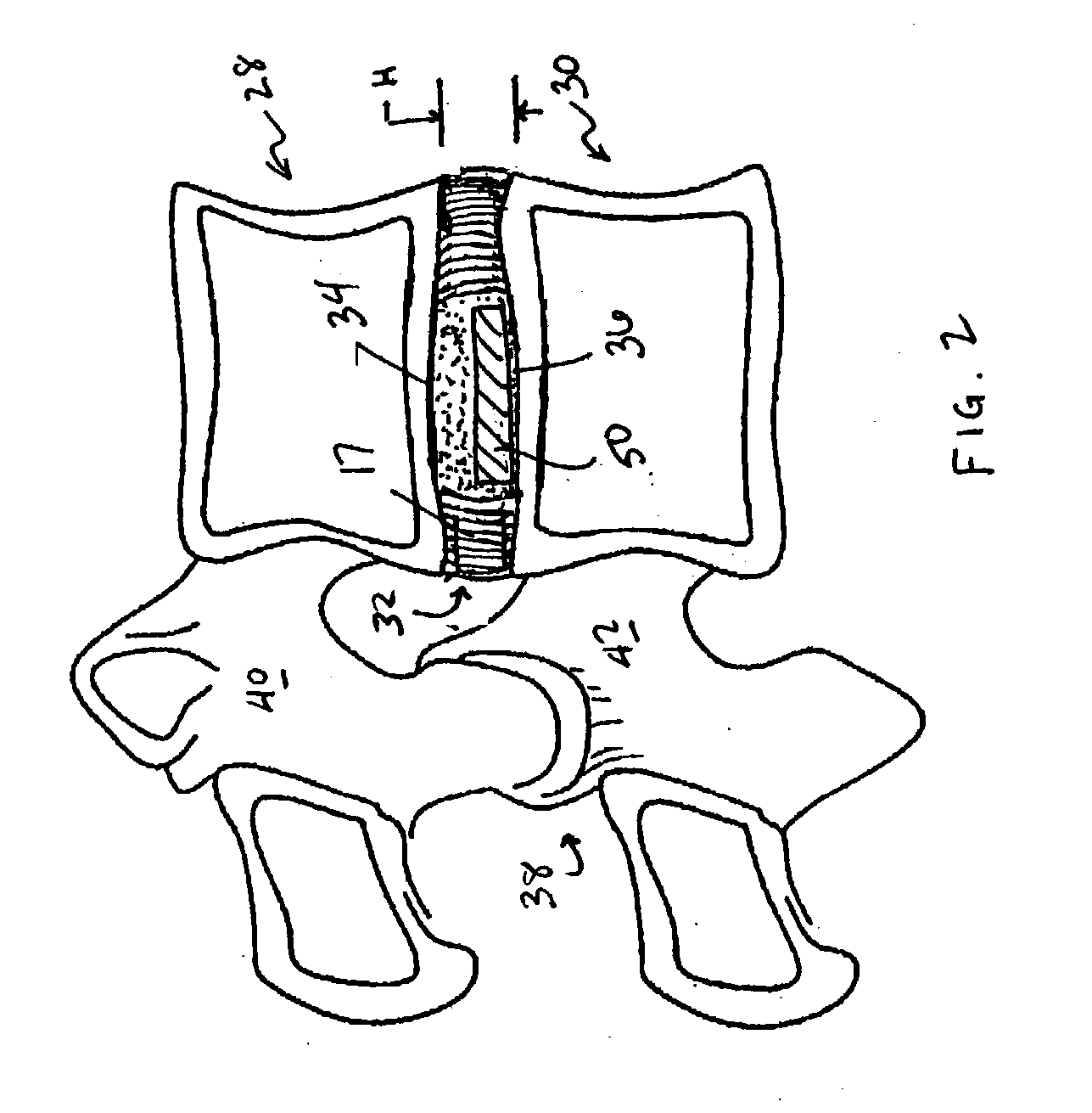 Devices and method for augmenting a vertebral disc
