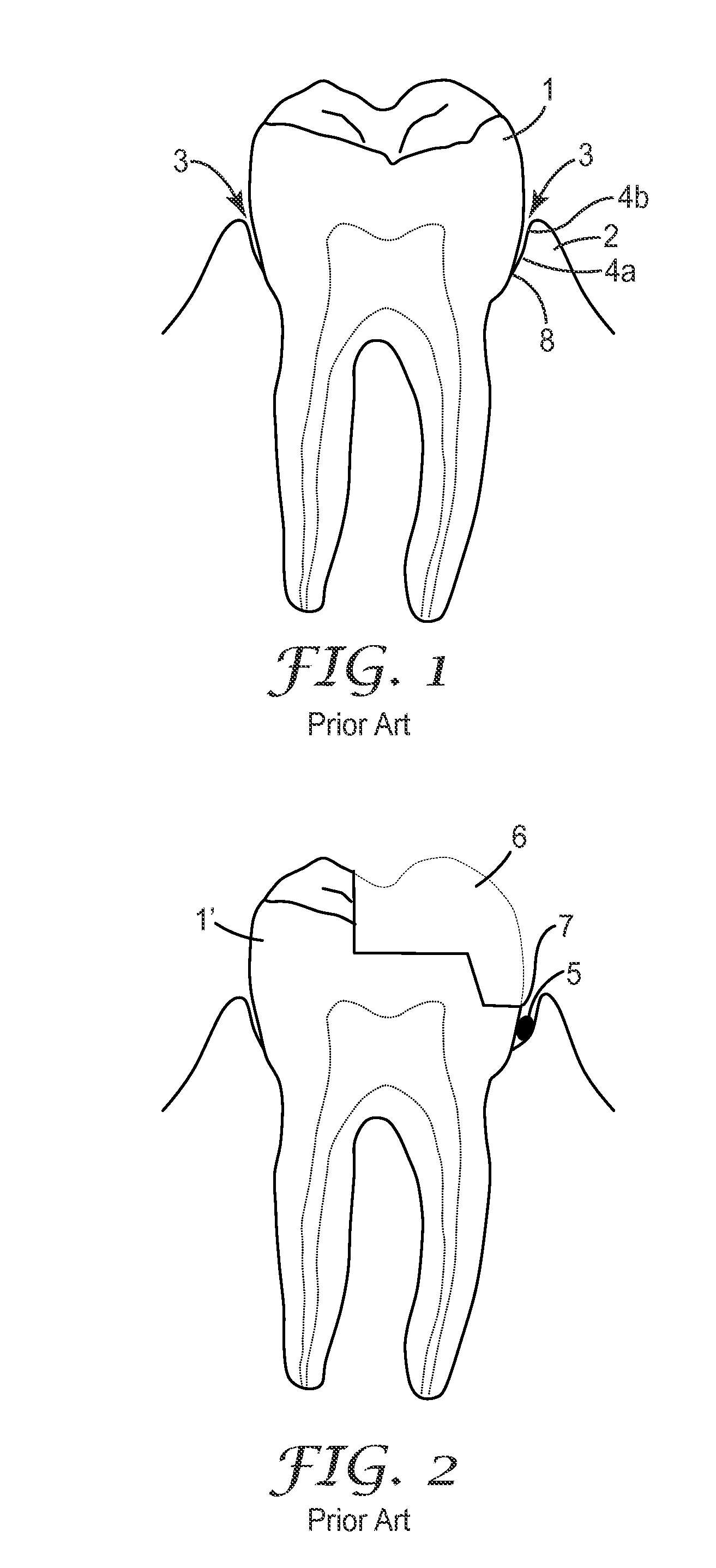 Device and a method for delivery of a dental composition