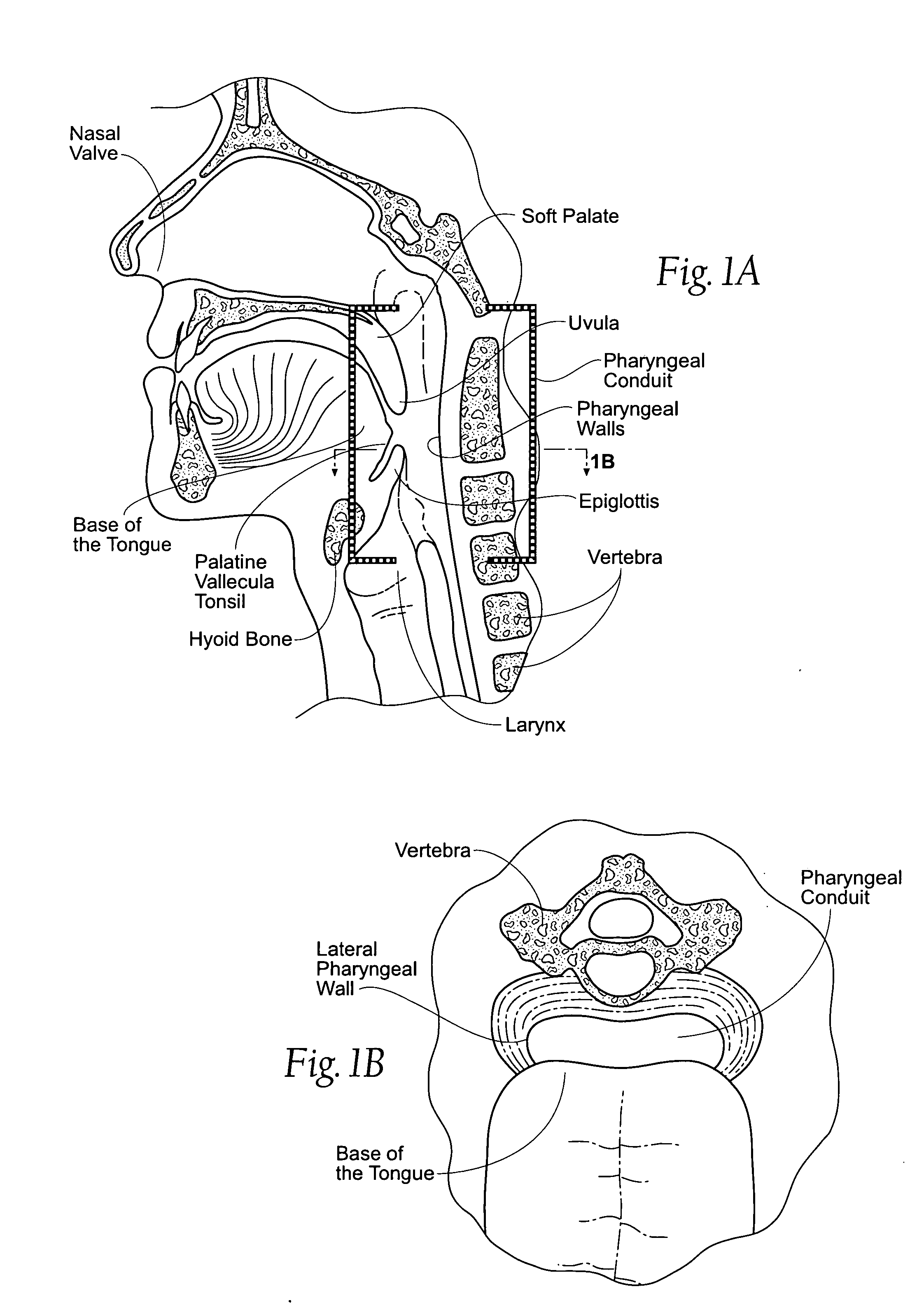 Devices, systems, and methods to fixate tissue within the regions of body, such as the pharyngeal conduit