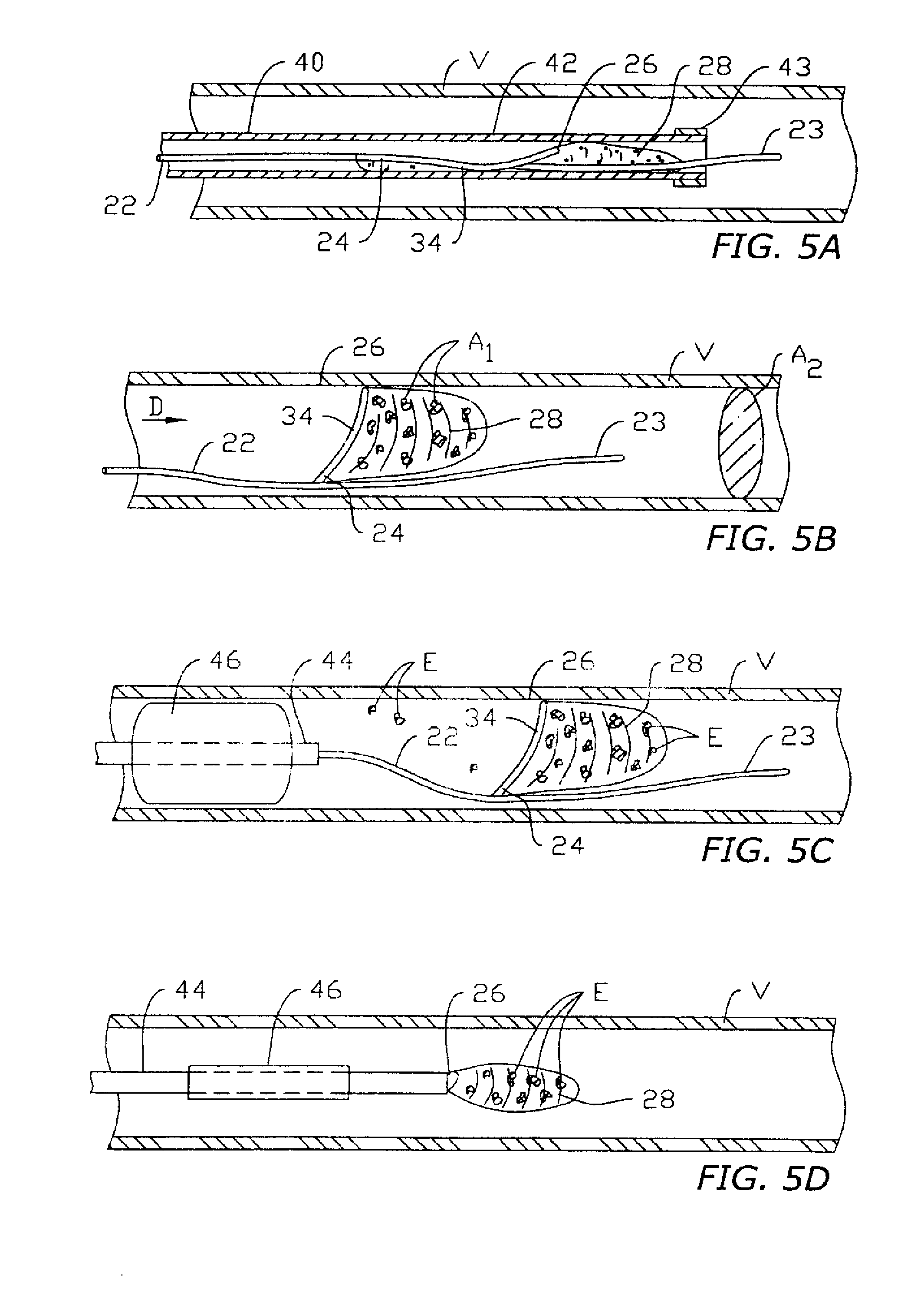 Vasculara device for emboli, thrombus and foreign body removal and methods of use