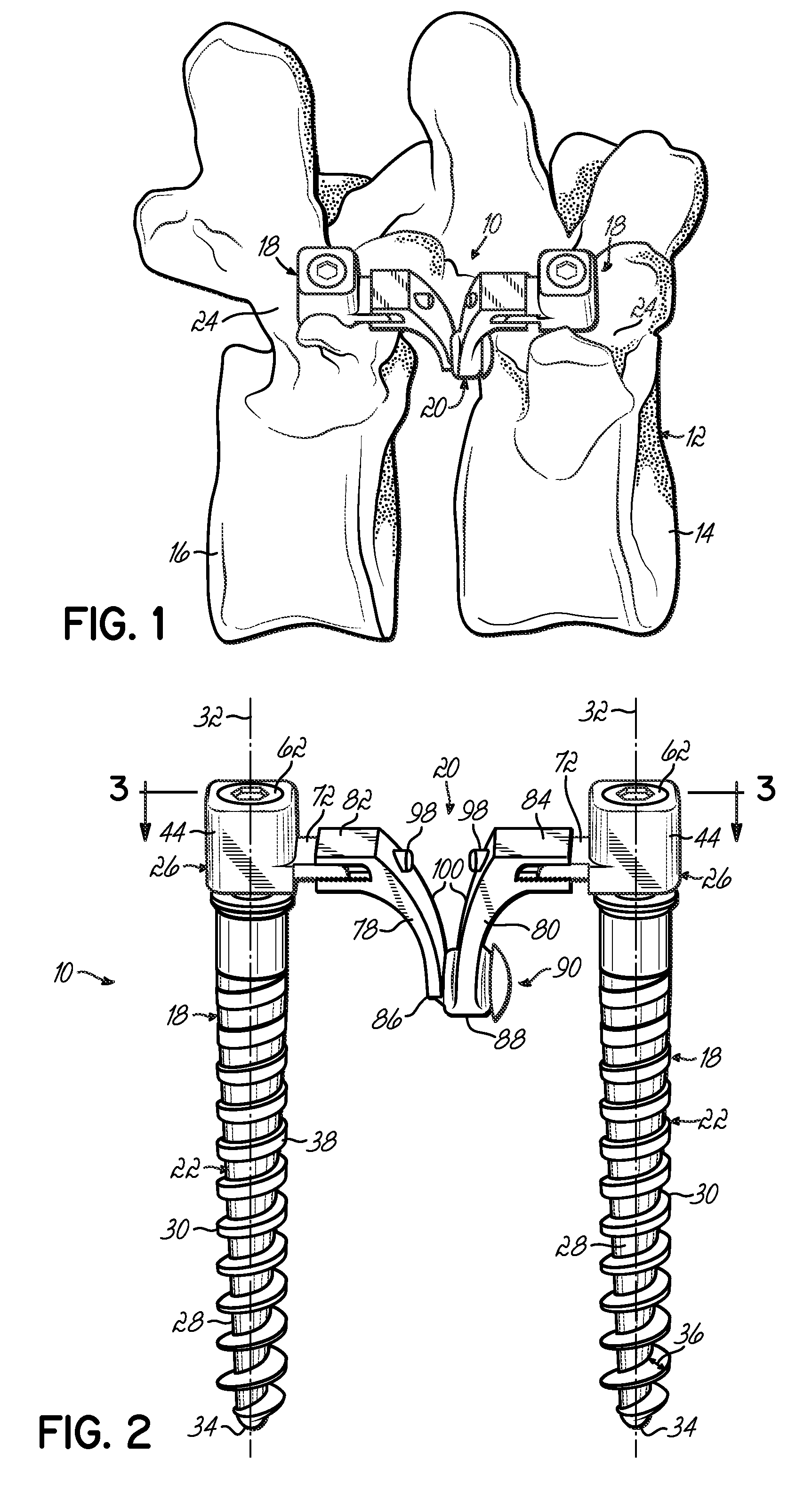 Dynamic spinal stabilization system and method of using the same