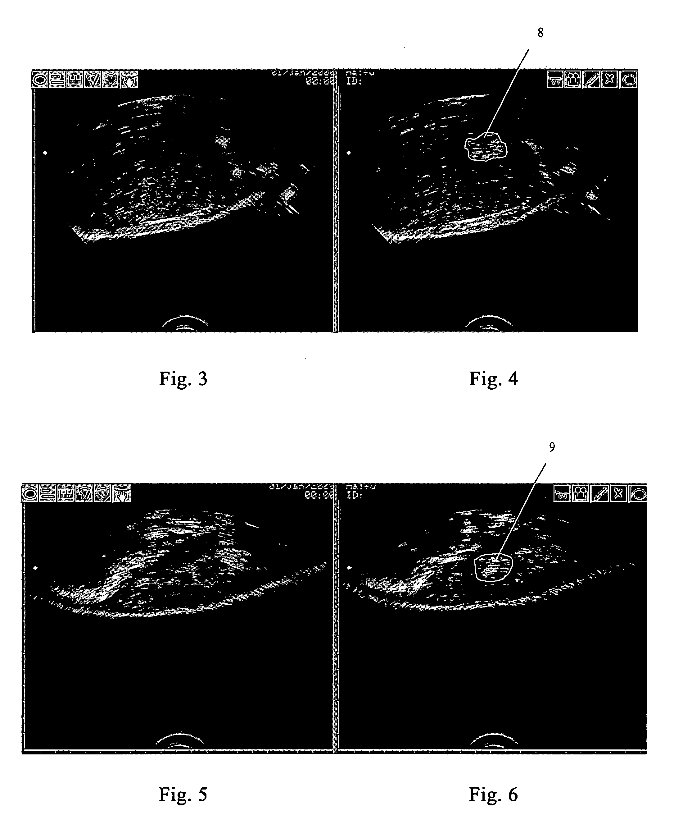 Method and Apparatus for High-Intensity Focused Ultrasound Therapy