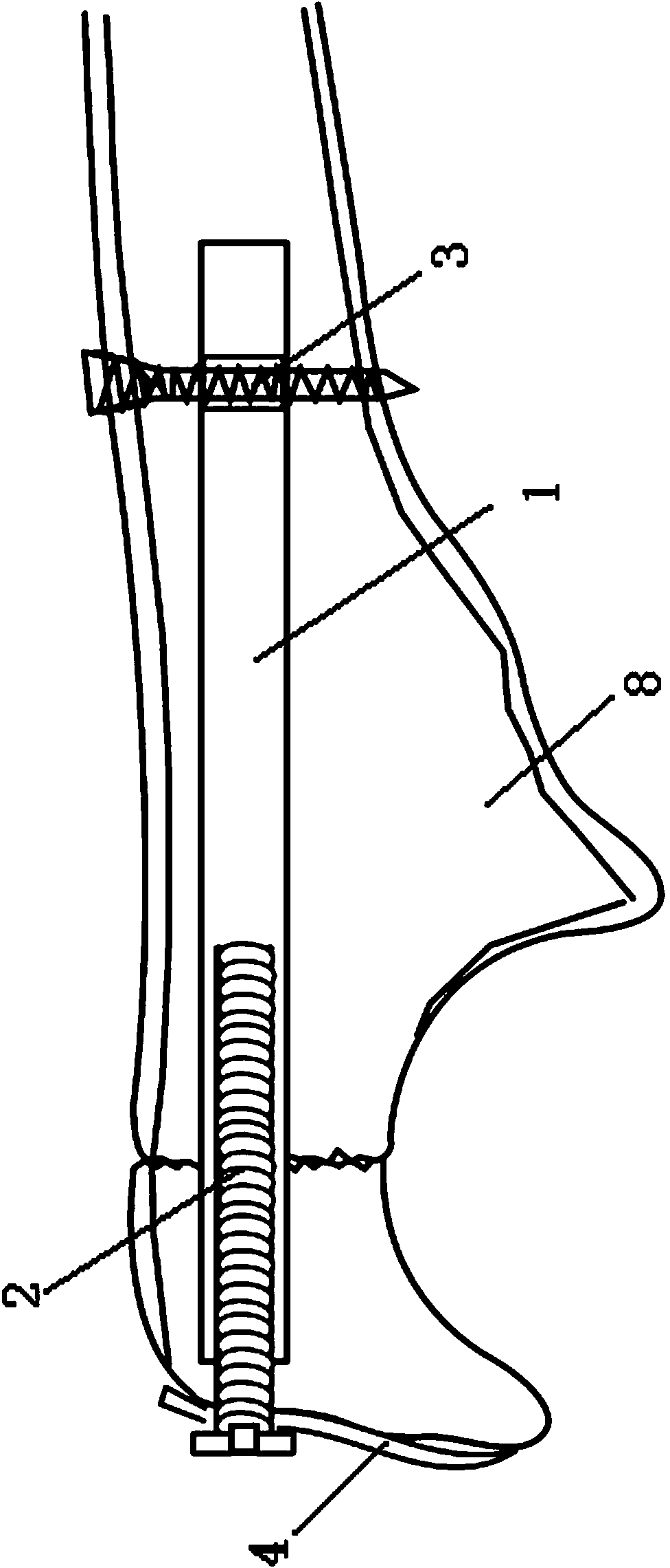 Intramedullary compression nail plate for olecroanon