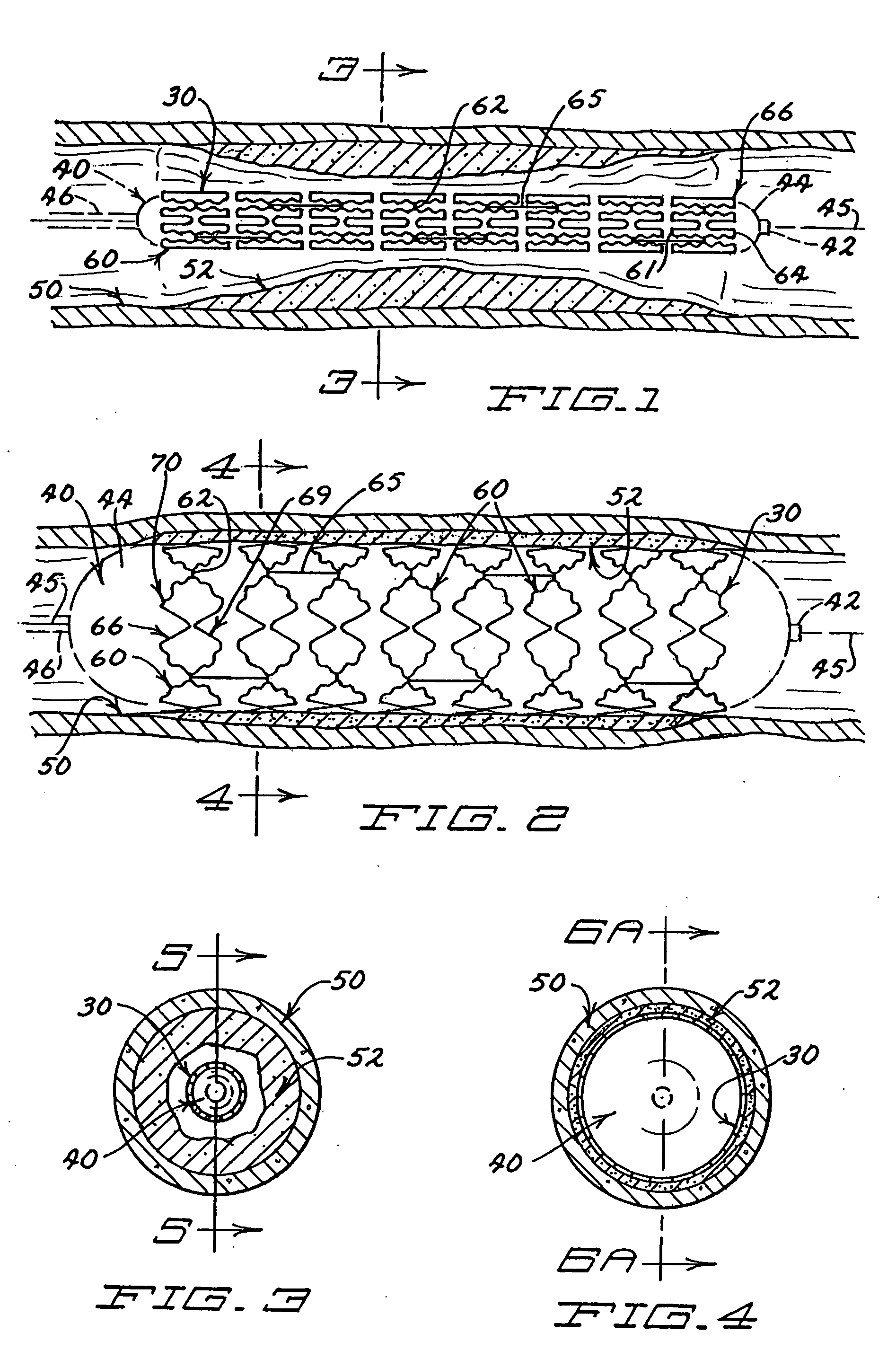 Expandable stent having plurality of interconnected expansion modules