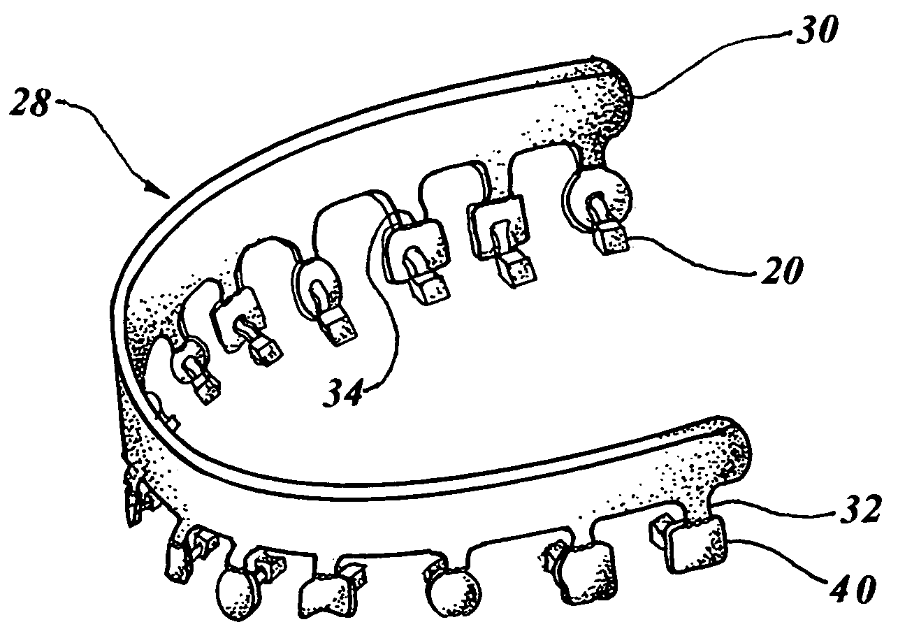 Computer configured appliance for orthodontic correction of malocclusions