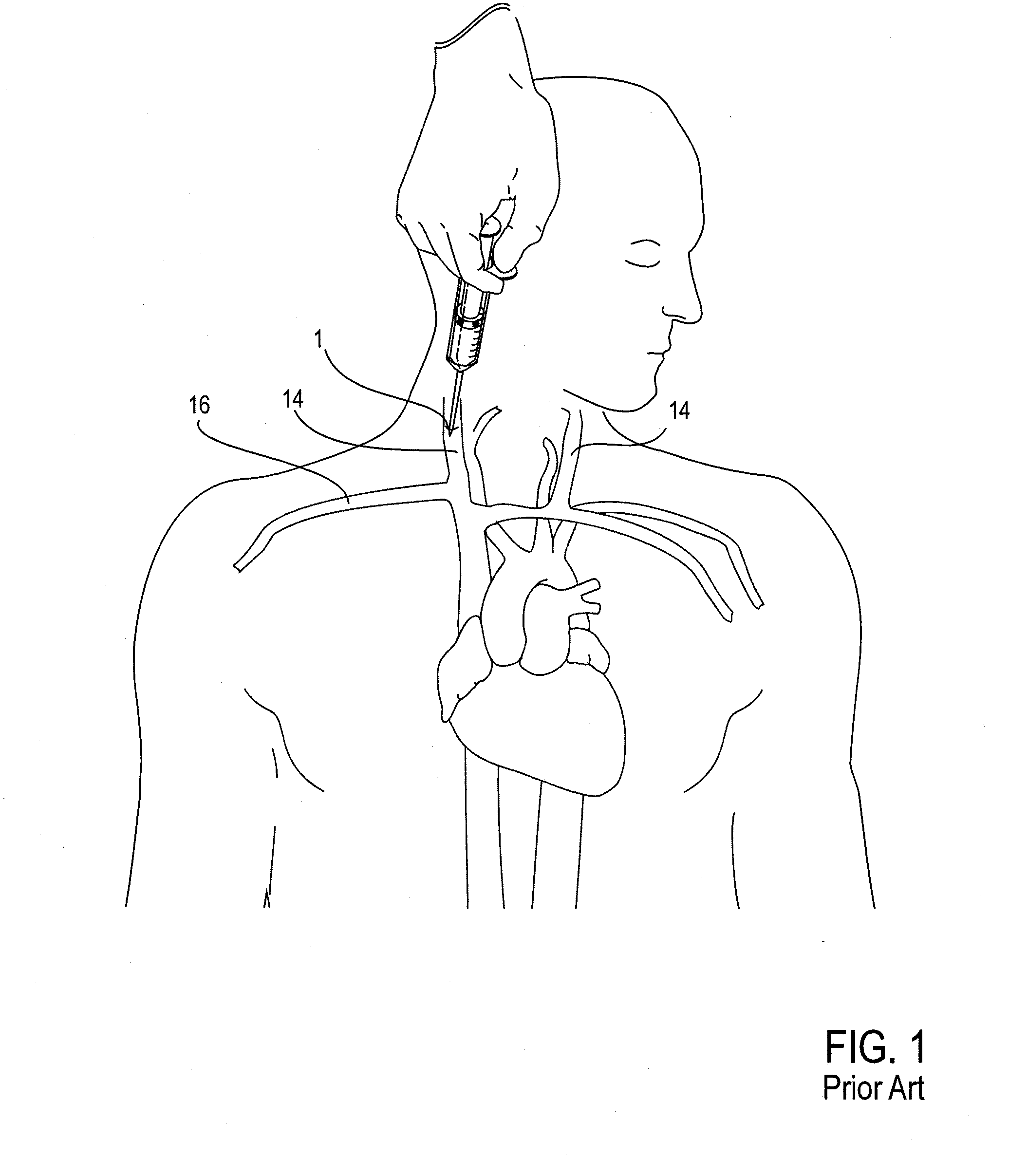 Methods of Transvascular Retrograde Access Placement and Devices for Facilitating the Placement
