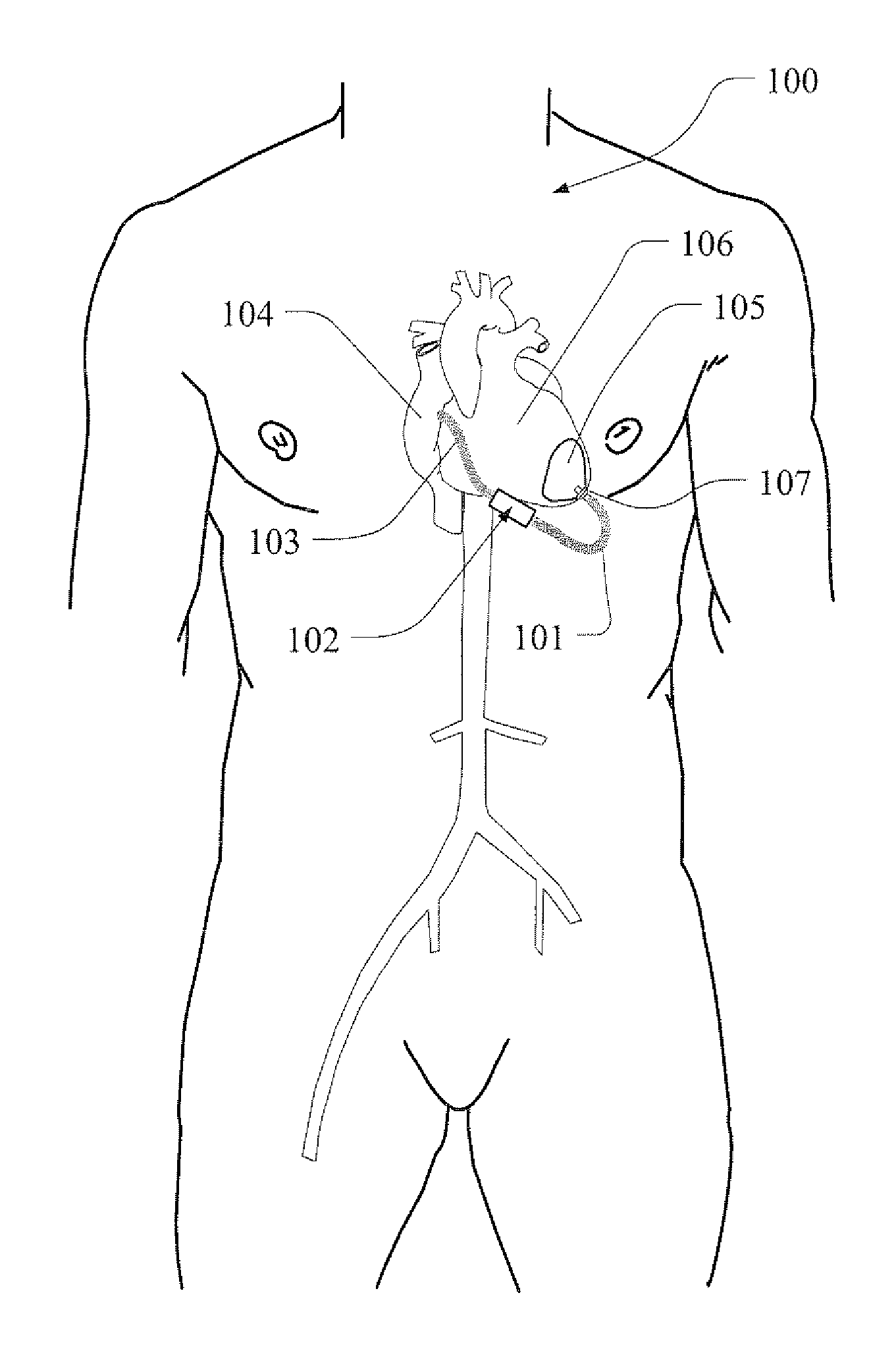 Method and apparatus to unload a failing heart