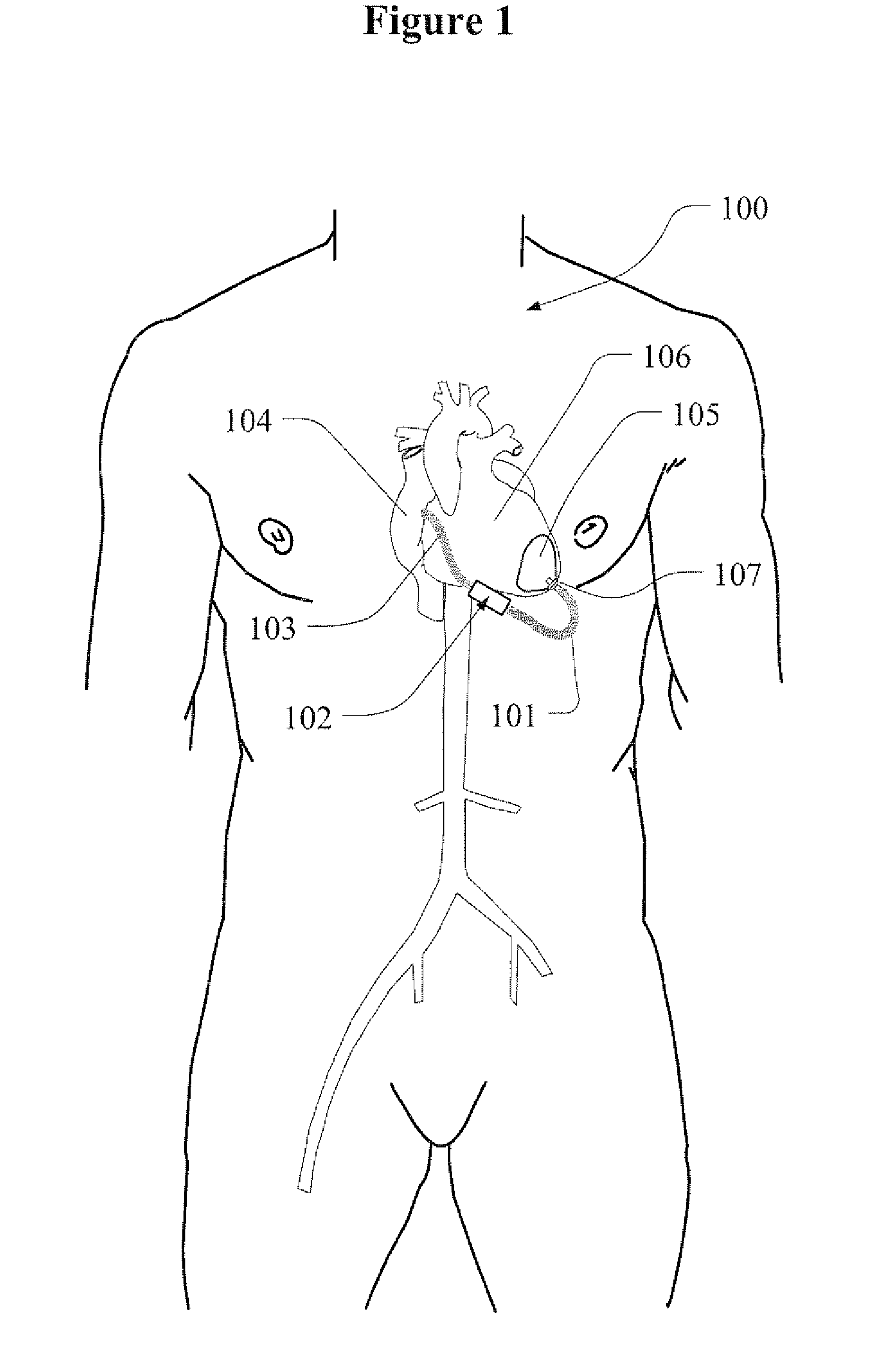 Method and apparatus to unload a failing heart