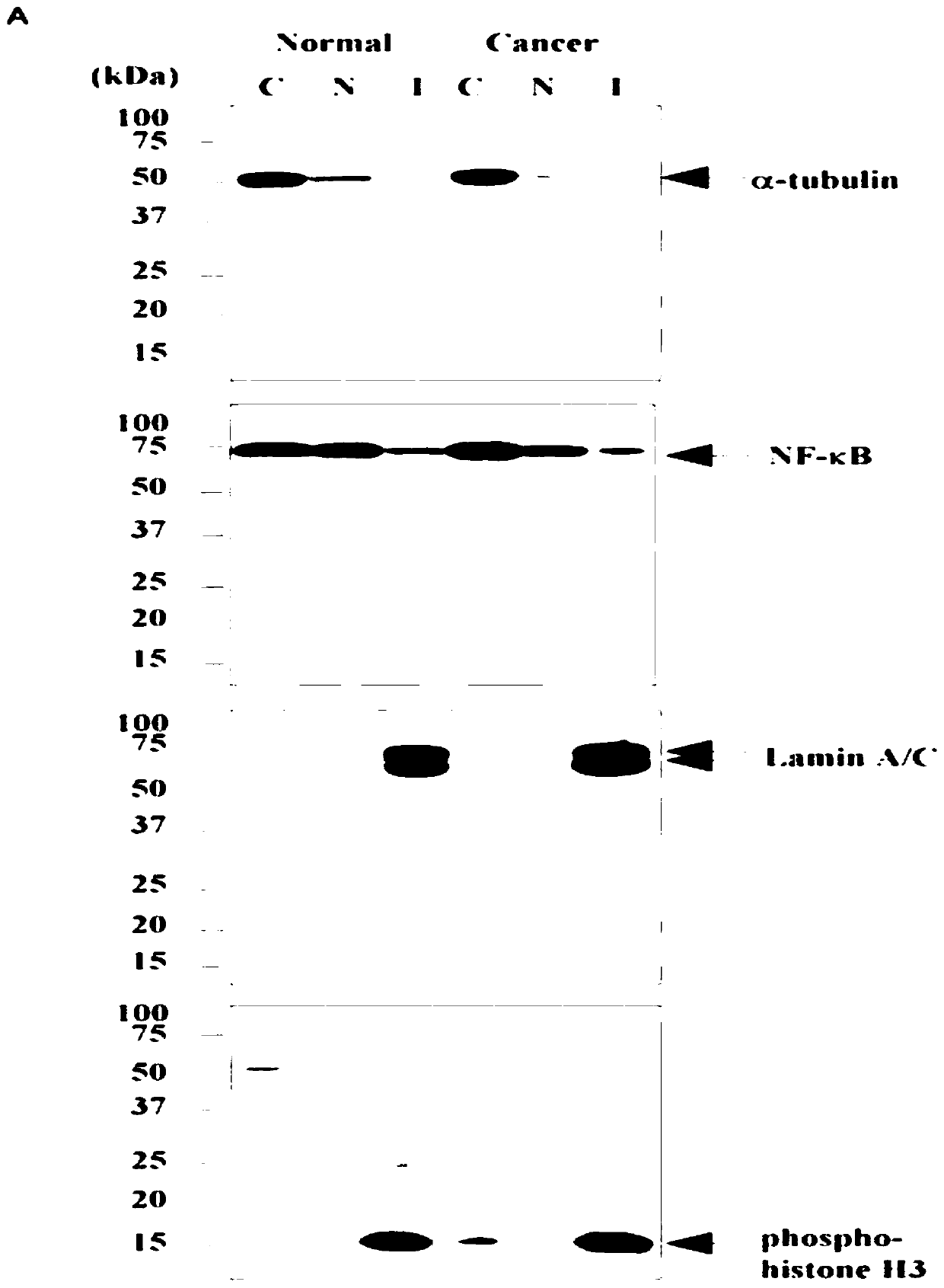 Purpose of survivin in preparation of colorectal cancer prognosis kit