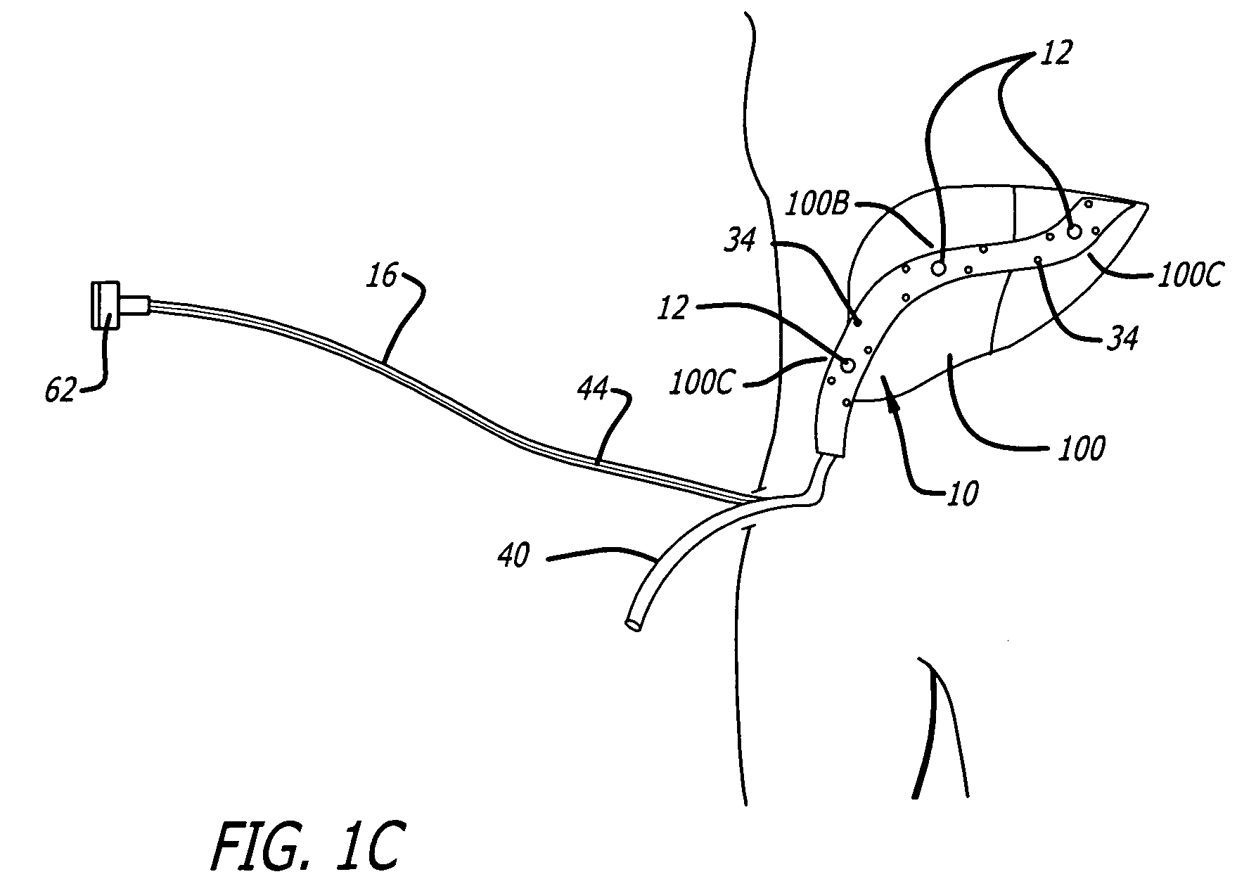 Surgical drain with sensors for monitoring internal tissue condition by transmittance