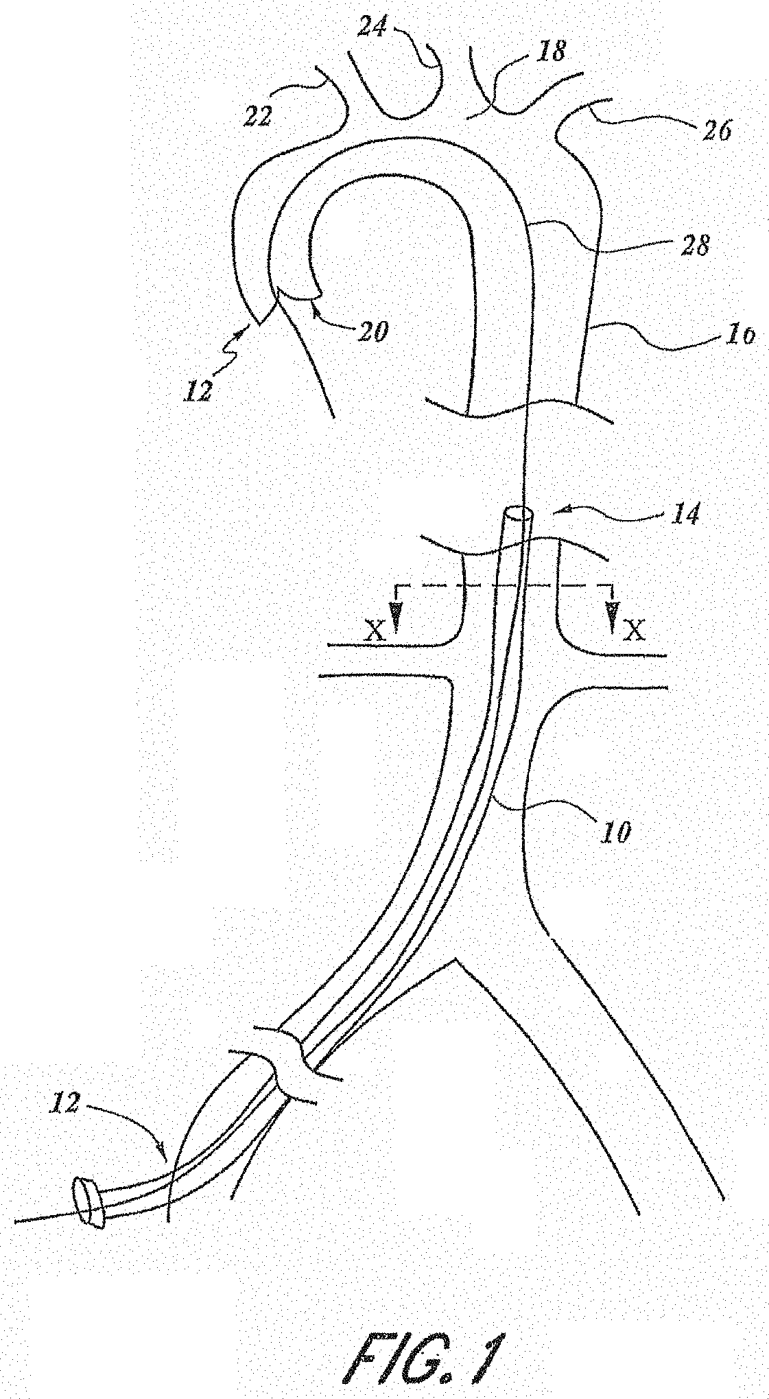 Embolic filter with controlled aperture size distribution