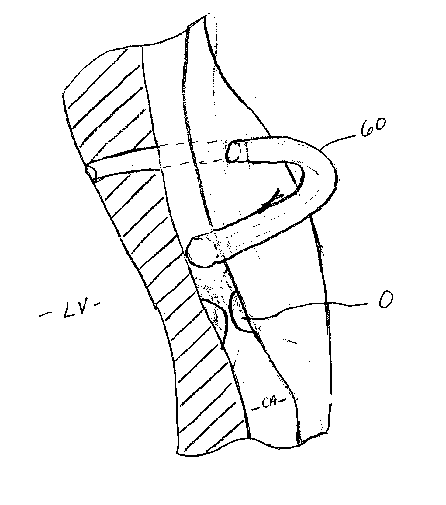 Methods for inducing vascular remodeling and related methods for treating diseased vascular structures