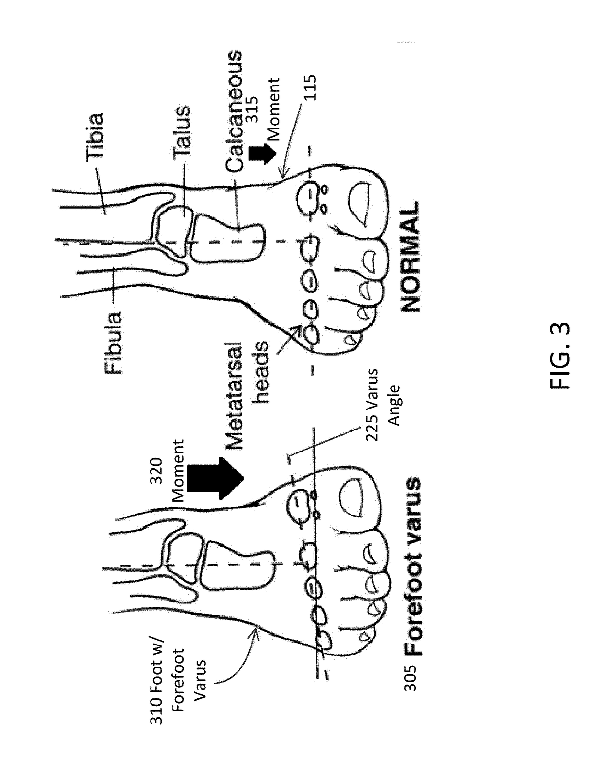 Method and apparatus to assist foot motion about the pronation axis