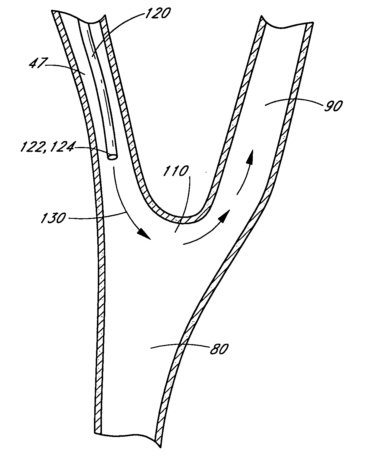 Method and apparatus for treating acute stroke