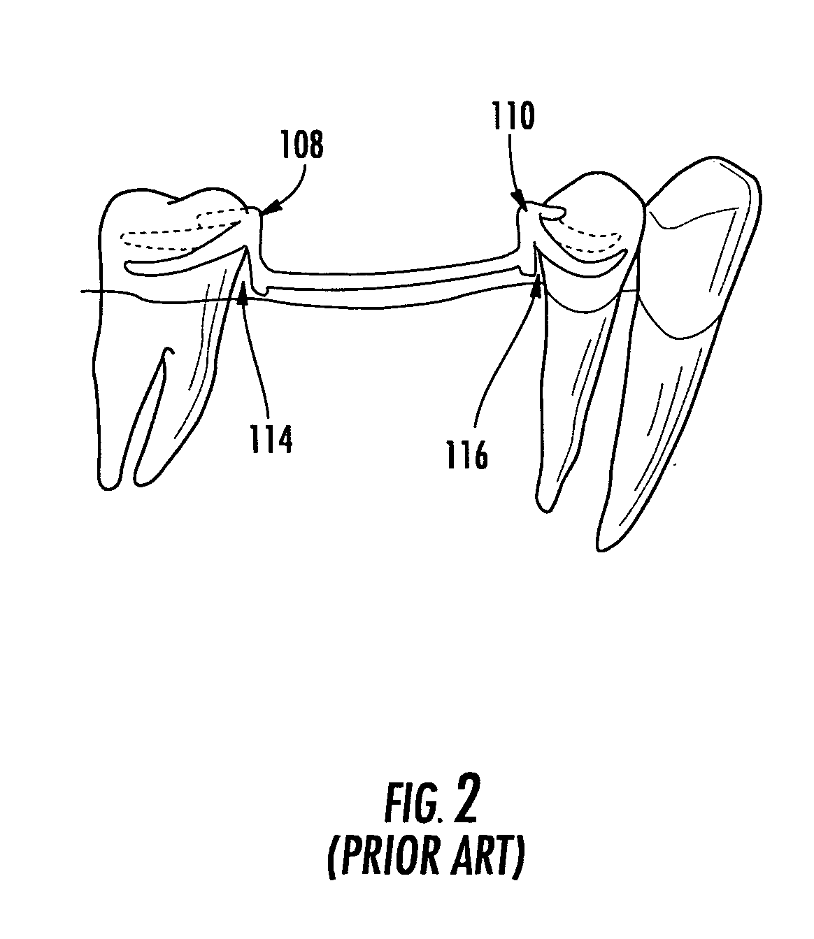 Denture device