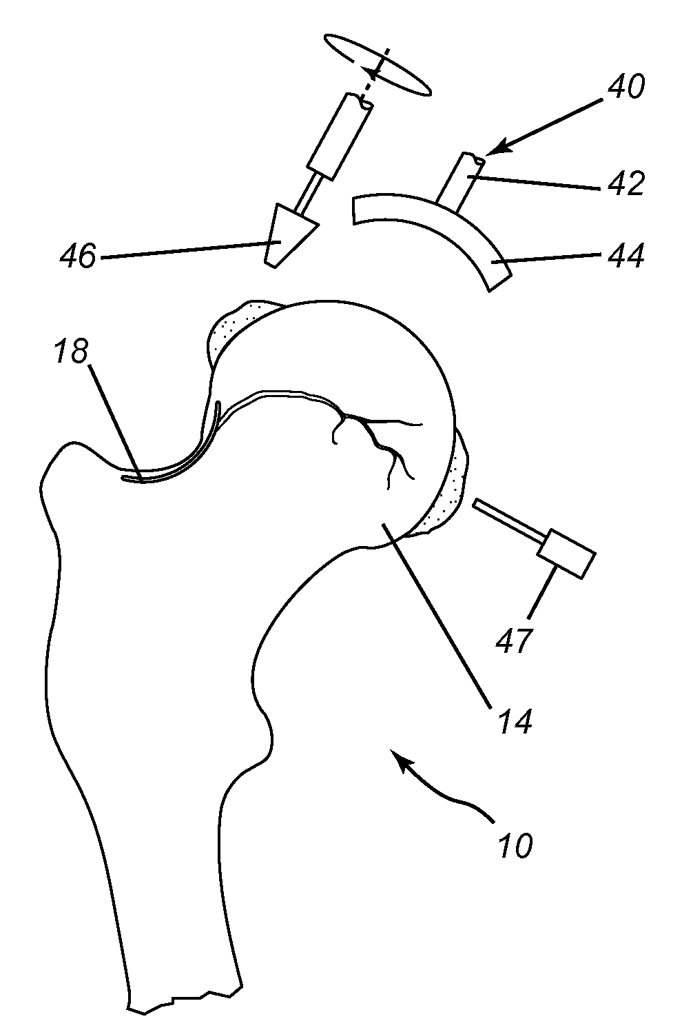 Surgical instrument tray, hip resurfacing kit, and method of resurfacing a femoral head to preserve femoral head vascularity