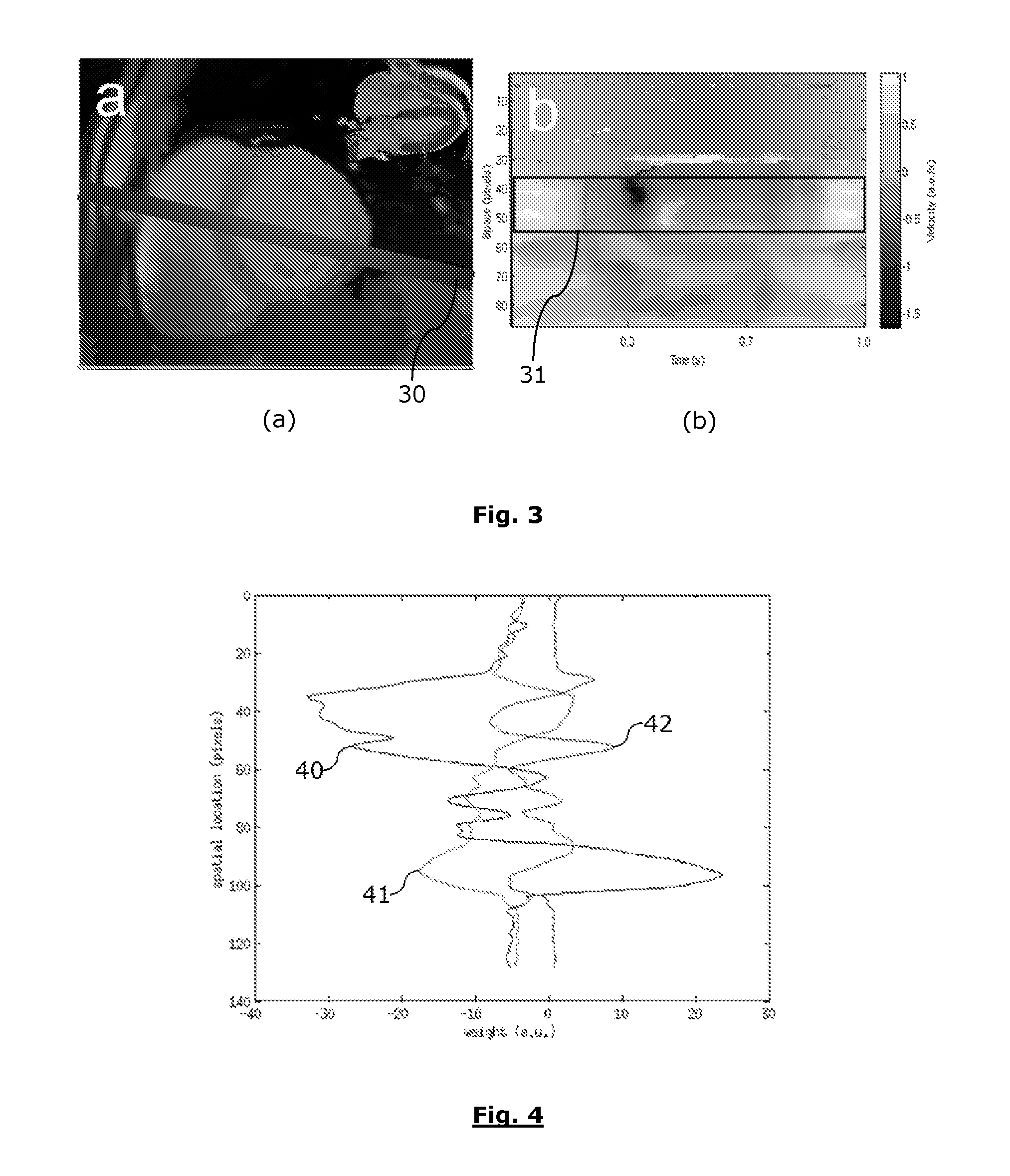 Method for determining a personalized cardiac model using a magnetic resonance imaging sequence