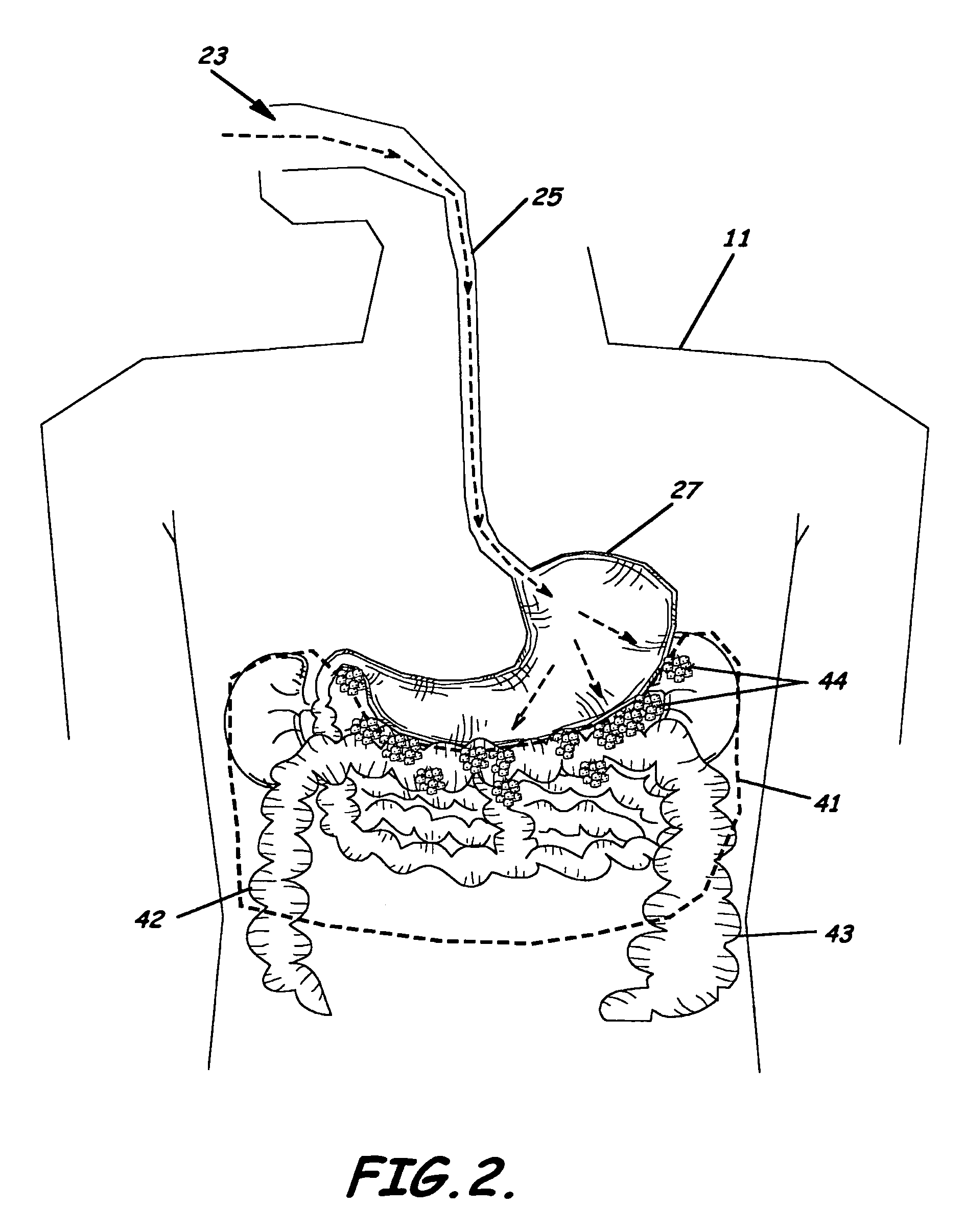 System, kit, and method of transgastric removal of visceral fat and other related methods