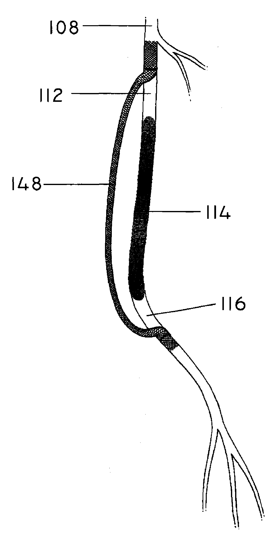 Methods and apparatus for extraluminal femoropopliteal bypass graft
