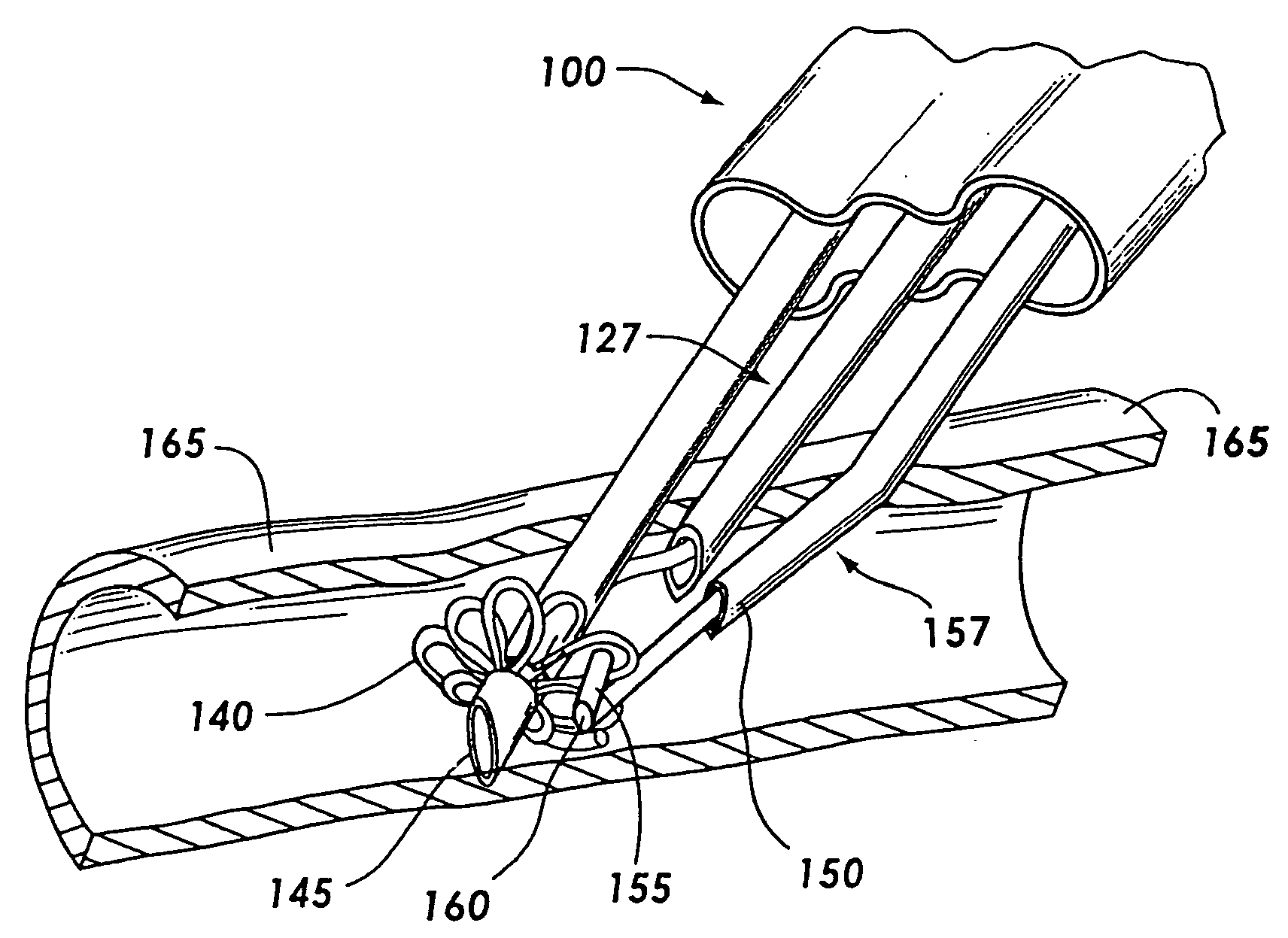 Three-needle closure device