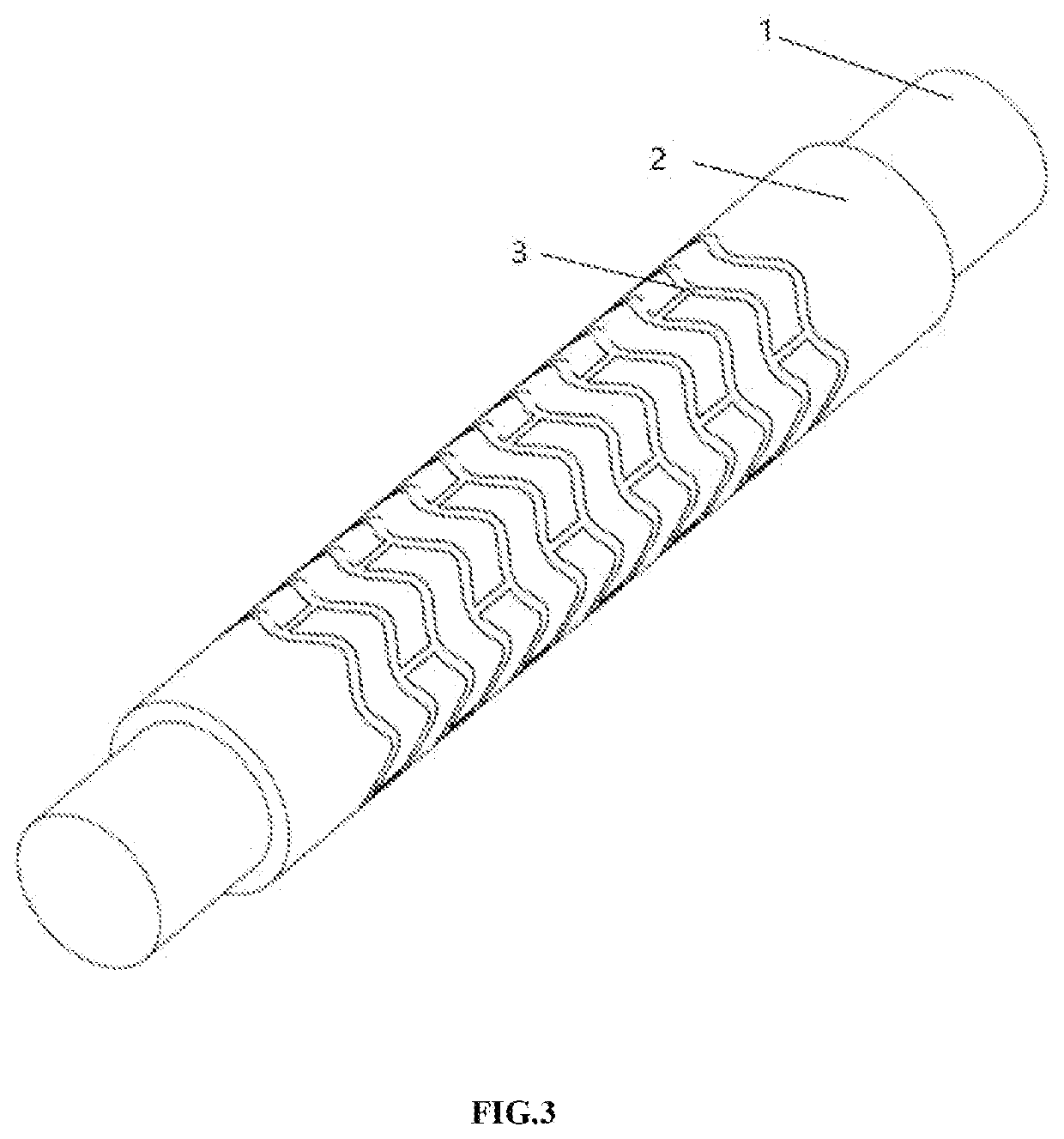 Injection Molding Method for Degradable Intravascular Stent with Flexible Mold Core Structure