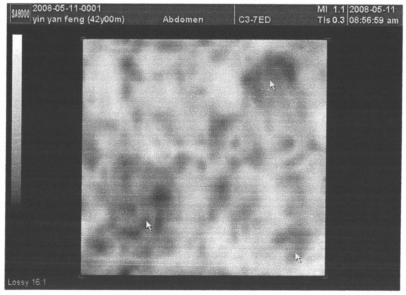 Three-dimensional ultrasonography-based early liver cancer diseased tissue target detection method
