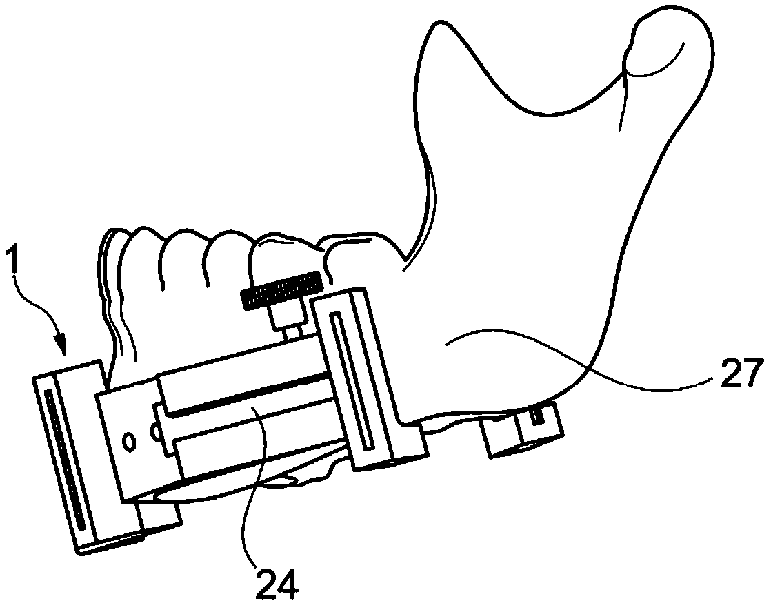 Fibula bone material removal and transfer template