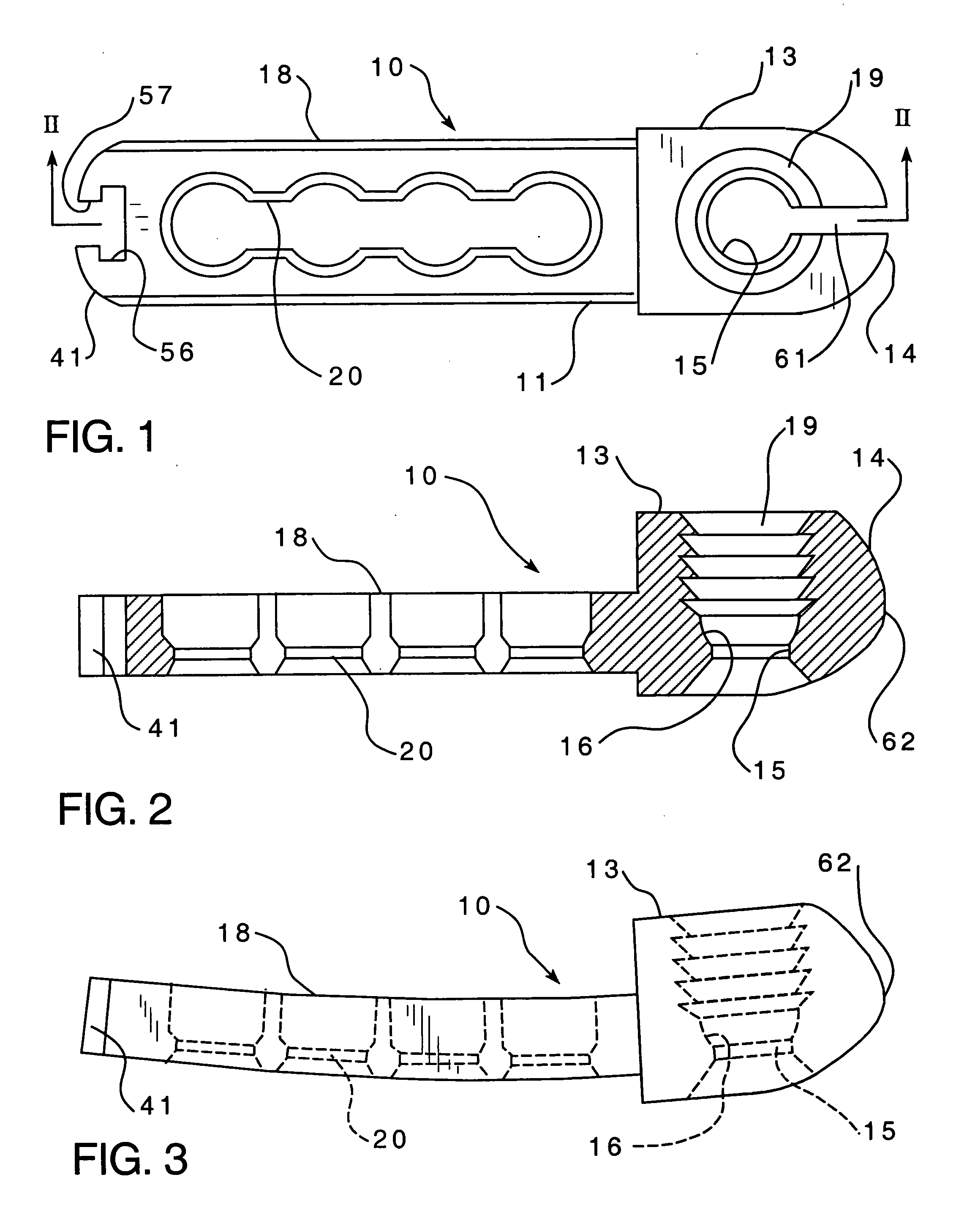 Spinal stabilization implant and method of application